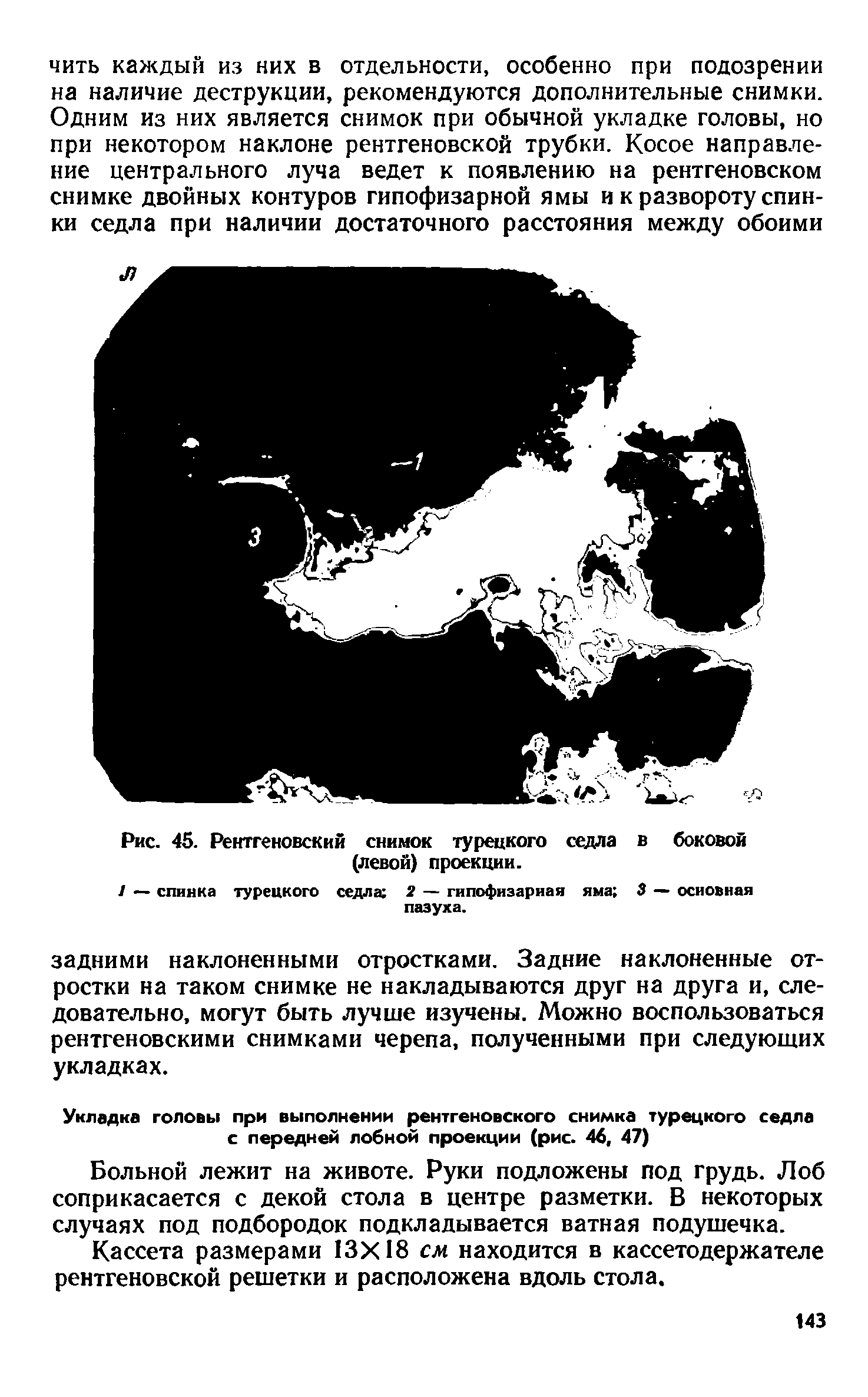 Рис. 45. Рентгеновский снимок турецкого седла в боковой (левой) проекции.