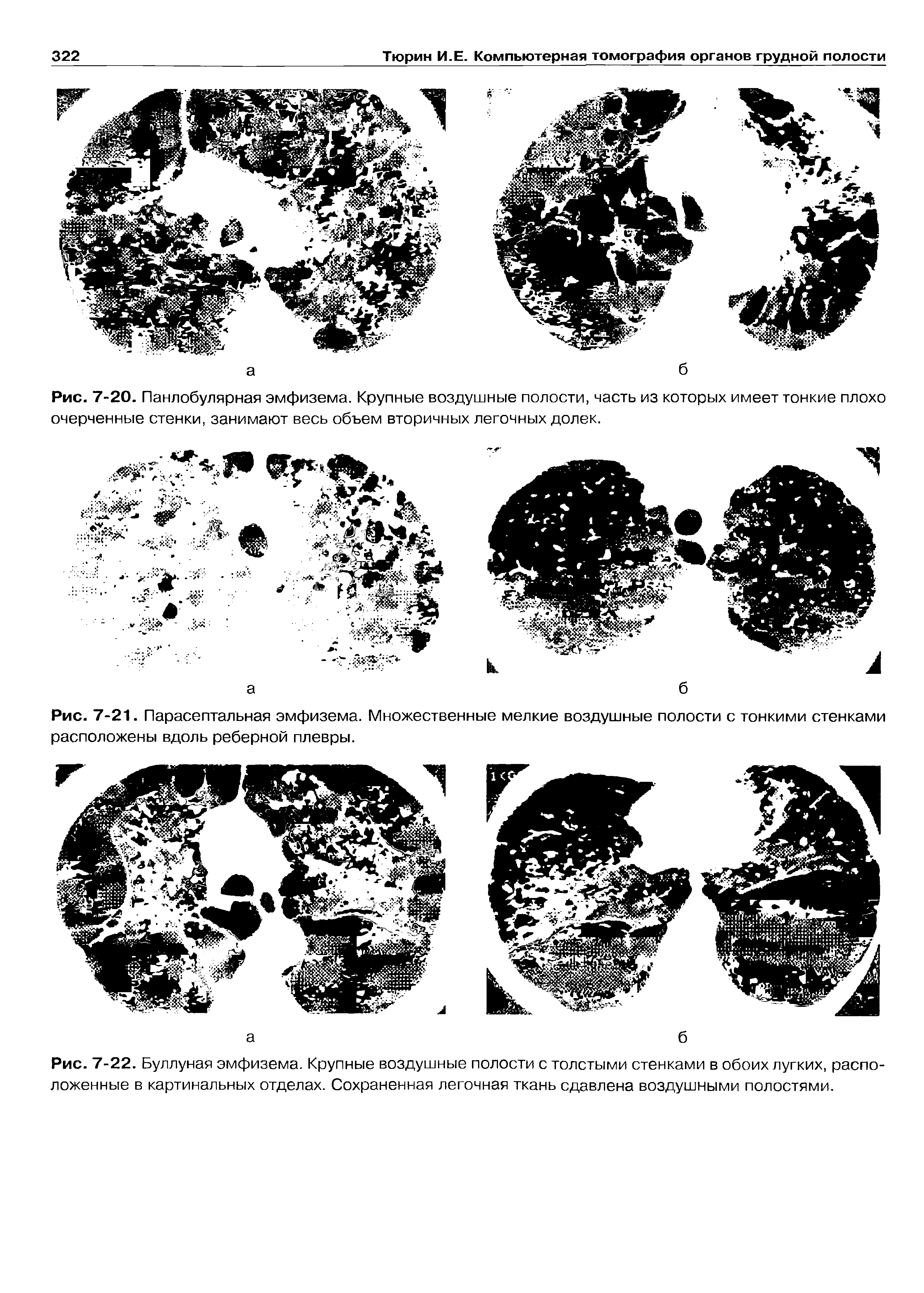 Рис. 7-22. Буллуная эмфизема. Крупные воздушные полости с толстыми стенками в обоих лугких, расположенные в картинальных отделах. Сохраненная легочная ткань сдавлена воздушными полостями.