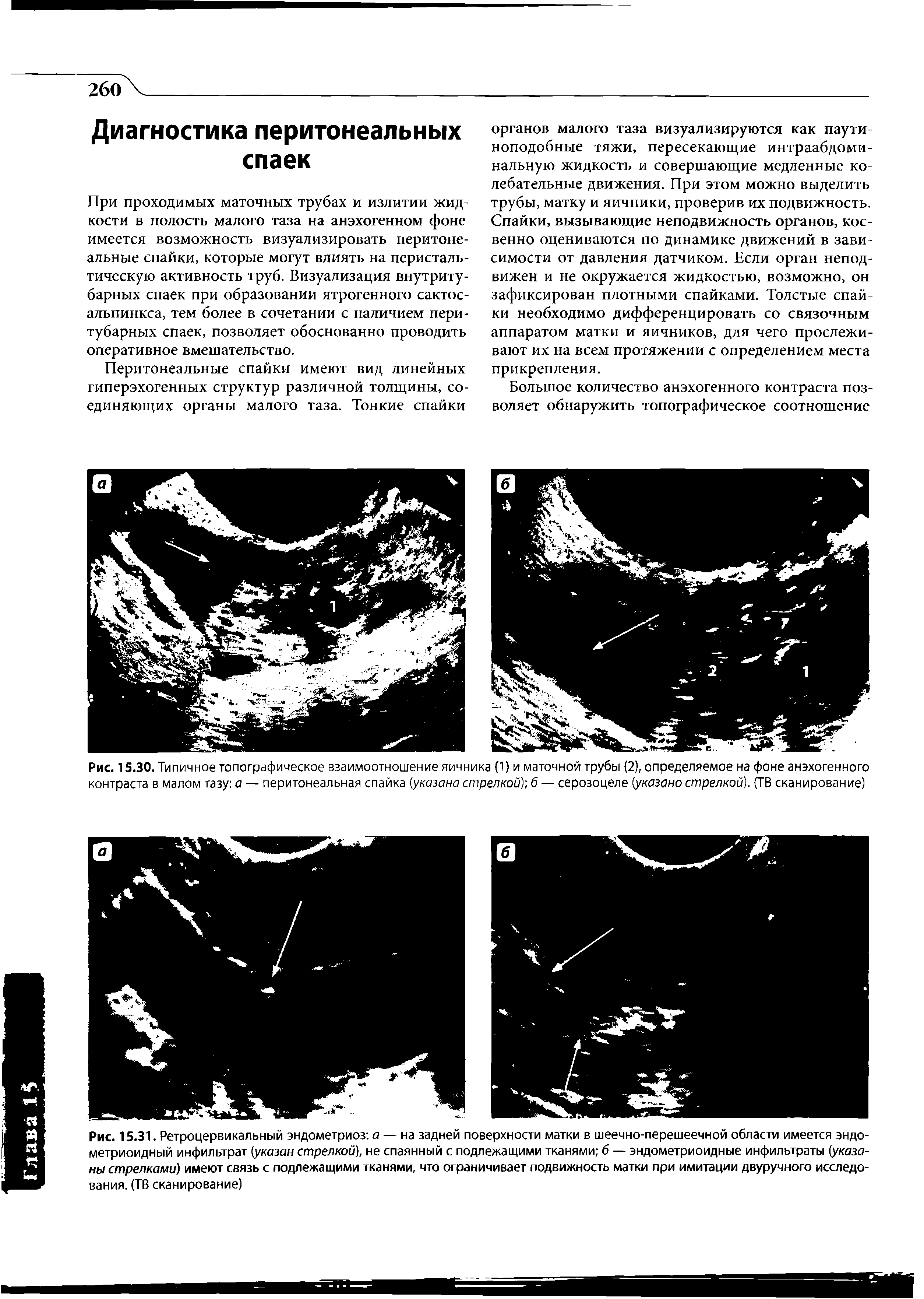 Рис. 15.30. Типичное топографическое взаимоотношение яичника (1) и маточной трубы (2), определяемое на фоне анэхогенного контраста в малом тазу а — перитонеальная спайка (указана стрелкой) б — серозоцеле (указано стрелкой). (ТВ сканирование)...