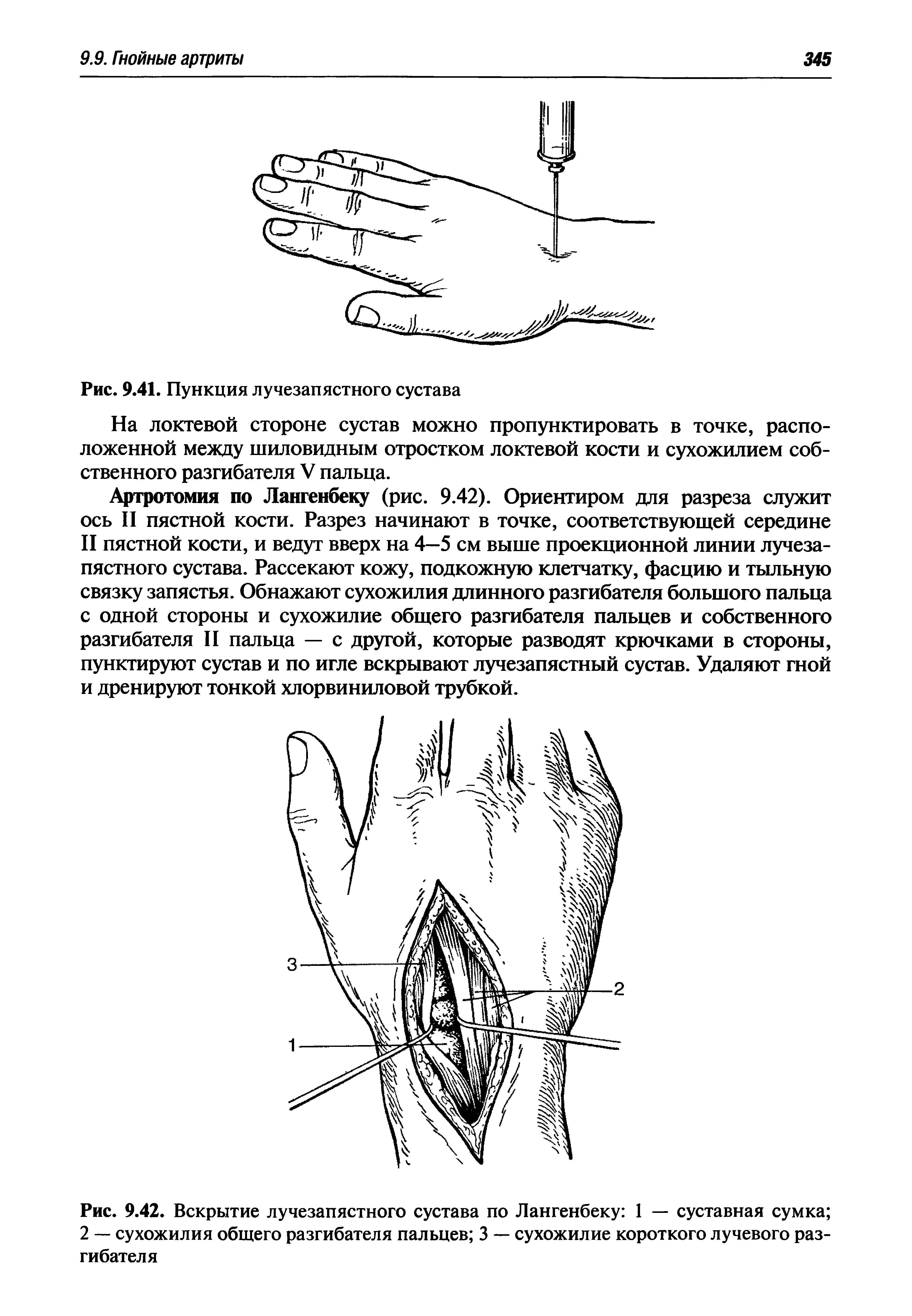 Рис. 9.42. Вскрытие лучезапястного сустава по Лангенбеку 1 — суставная сумка ...