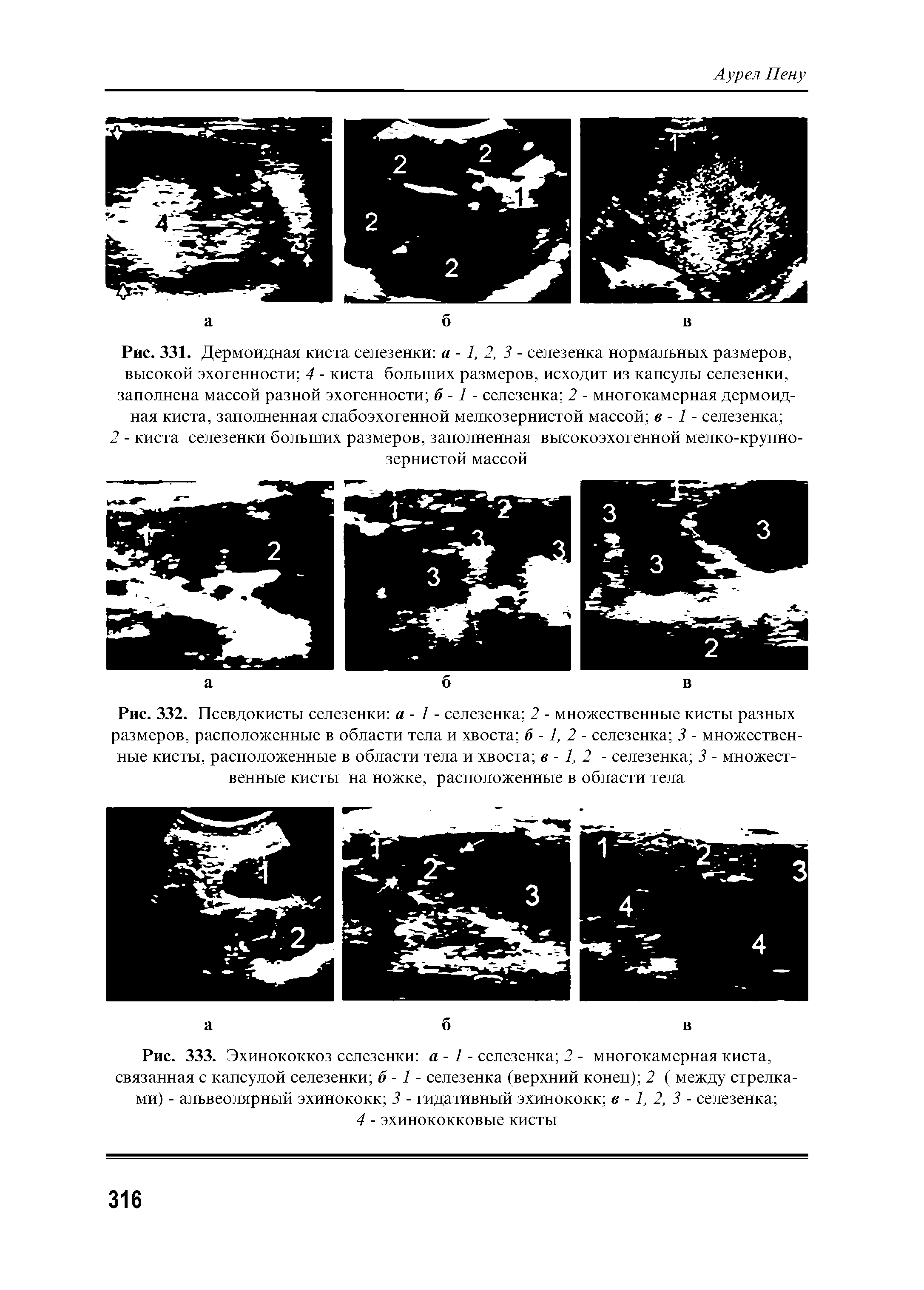 Рис. 333. Эхинококкоз селезенки а - 1 - селезенка 2 - многокамерная киста, связанная с капсулой селезенки б -1 - селезенка (верхний конец) 2 ( между стрелками) - альвеолярный эхинококк 3 - гидативный эхинококк в -1, 2, 3 - селезенка ...