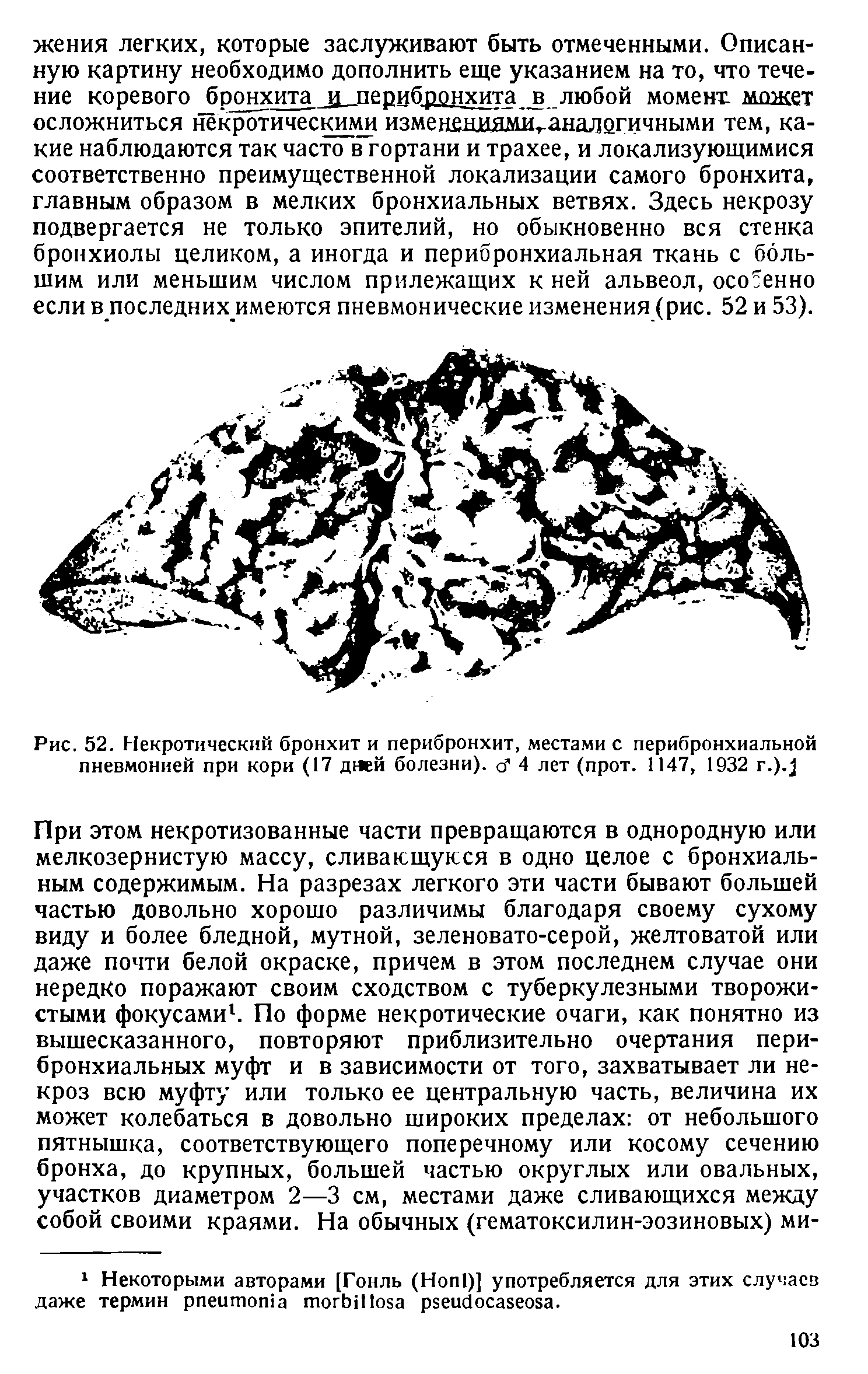 Рис. 52. Некротический бронхит и перибронхит, местами с перибронхиальной пневмонией при кори (17 дней болезни), д 4 лет (прот. 1147, 1932 г.) ...