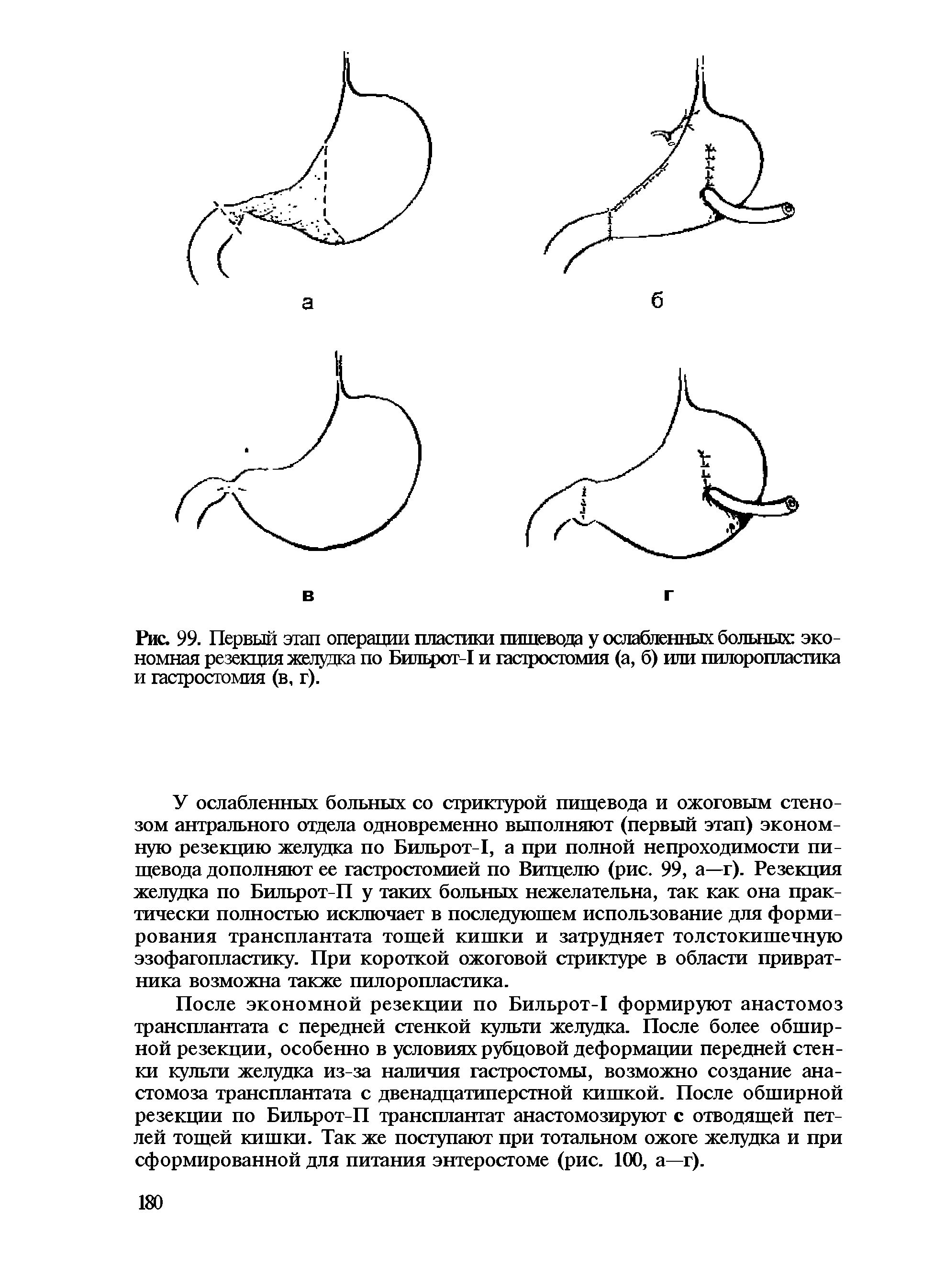 Рис. 99. Первый этап операции пластики пищевода у ослабленных больных экономная резекция желудка по Бильрот-1 и гастростомия (а, б) или пилоропластика и гастростомия (в, г).