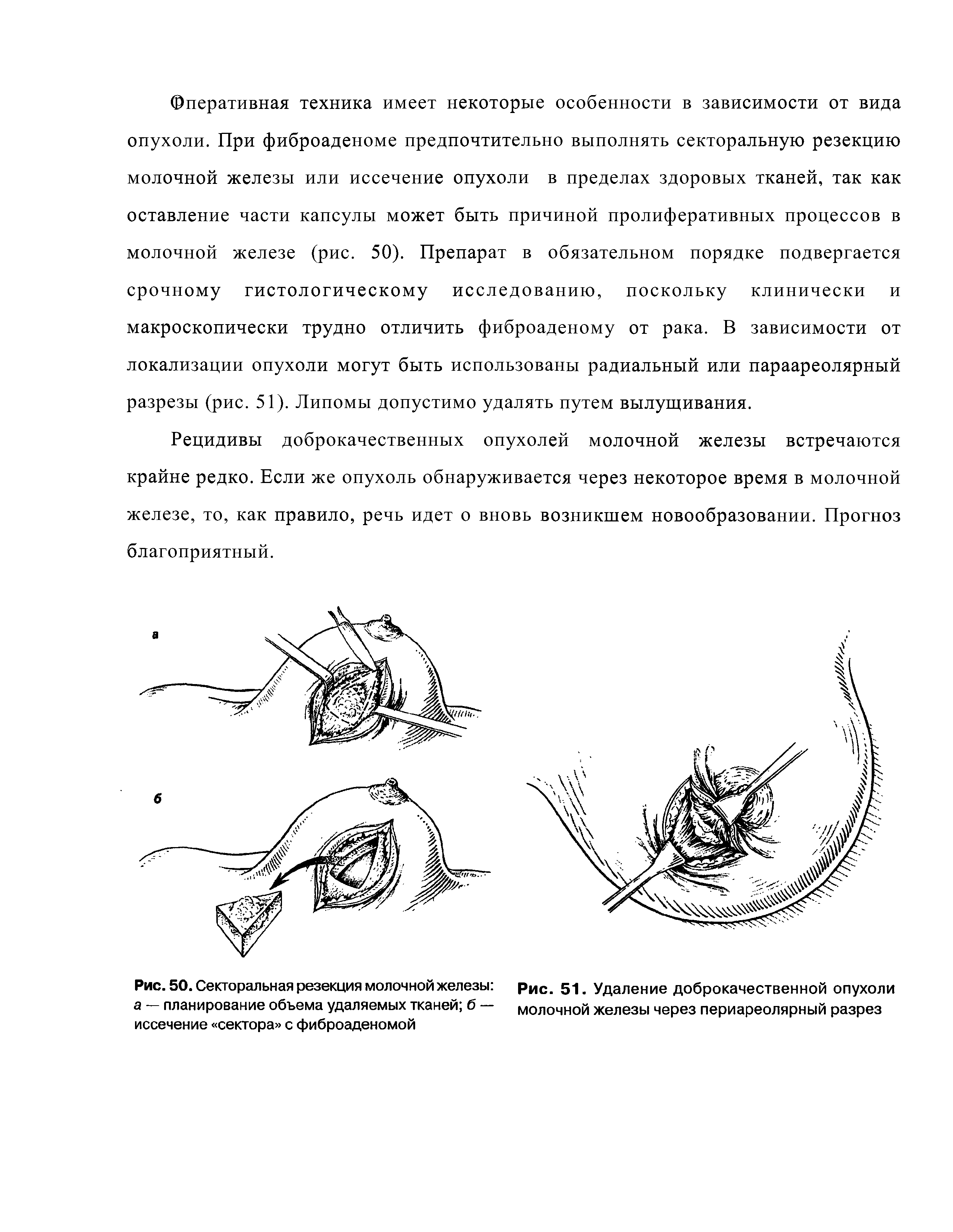 Рис. 50. Секторальная резекция молочной железы Рис. 51. Удаление доброкачественной опухоли...