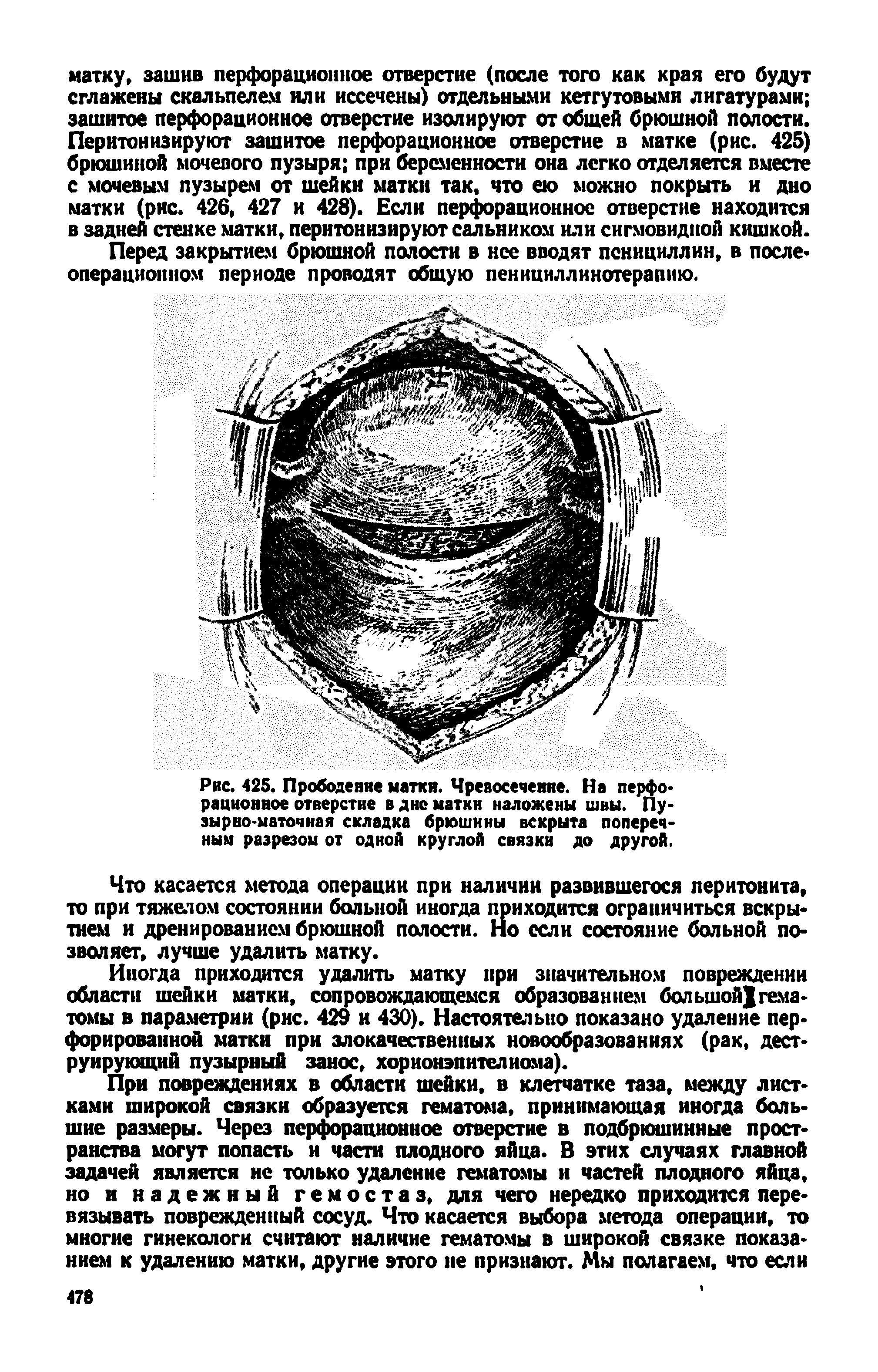 Рис. 425. Прободение матки. Чревосечение. На перфорационное отверстие в дне матки наложены швы. Пузырно-маточная складка брюшины вскрыта поперечным разрезом от одной круглой связки до другой.