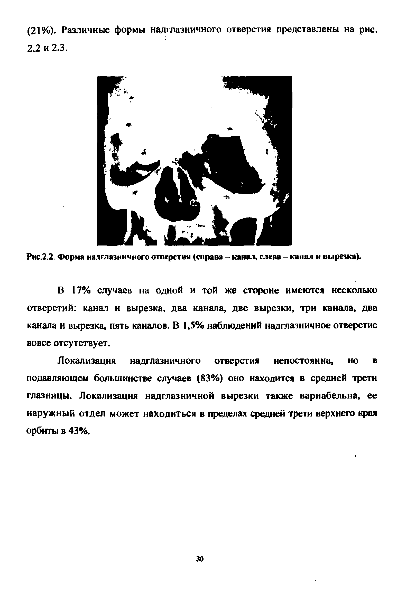 Рис.2.2. Форма надглазничного отверстия (справа - канал, слева - канал н вырезка) ...