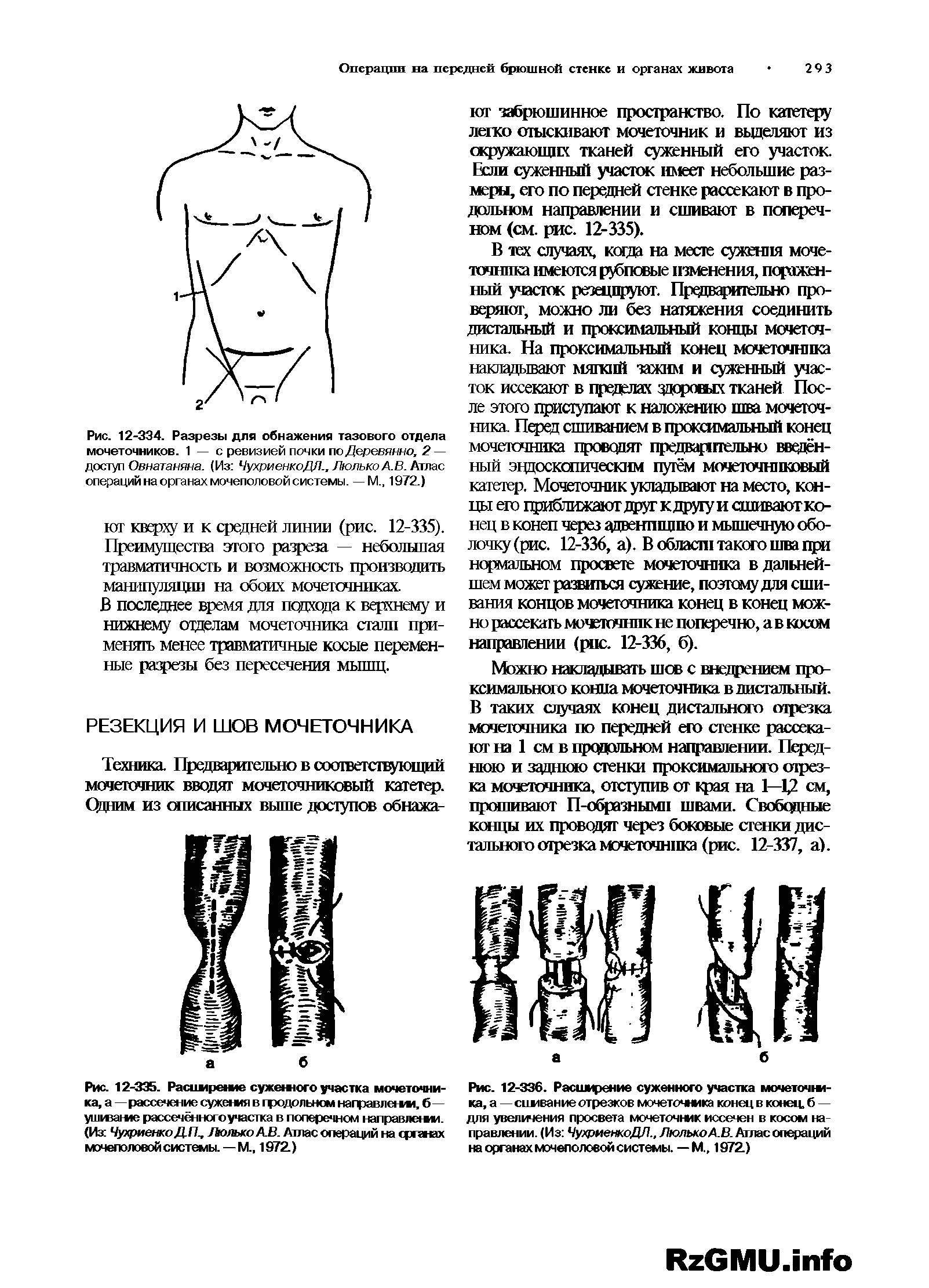 Рис. 12-336. Расширение суженного участка мочеточж-ка, а — сшивание отрезков мочеточника конец в конец, б — для увеличения просвета мочеточник иссечен в косом направлении. (Из ЧухриенкоДП., Люлько А.В. Аглае операций на органах мочеполовой системы. — М., 1972.)...