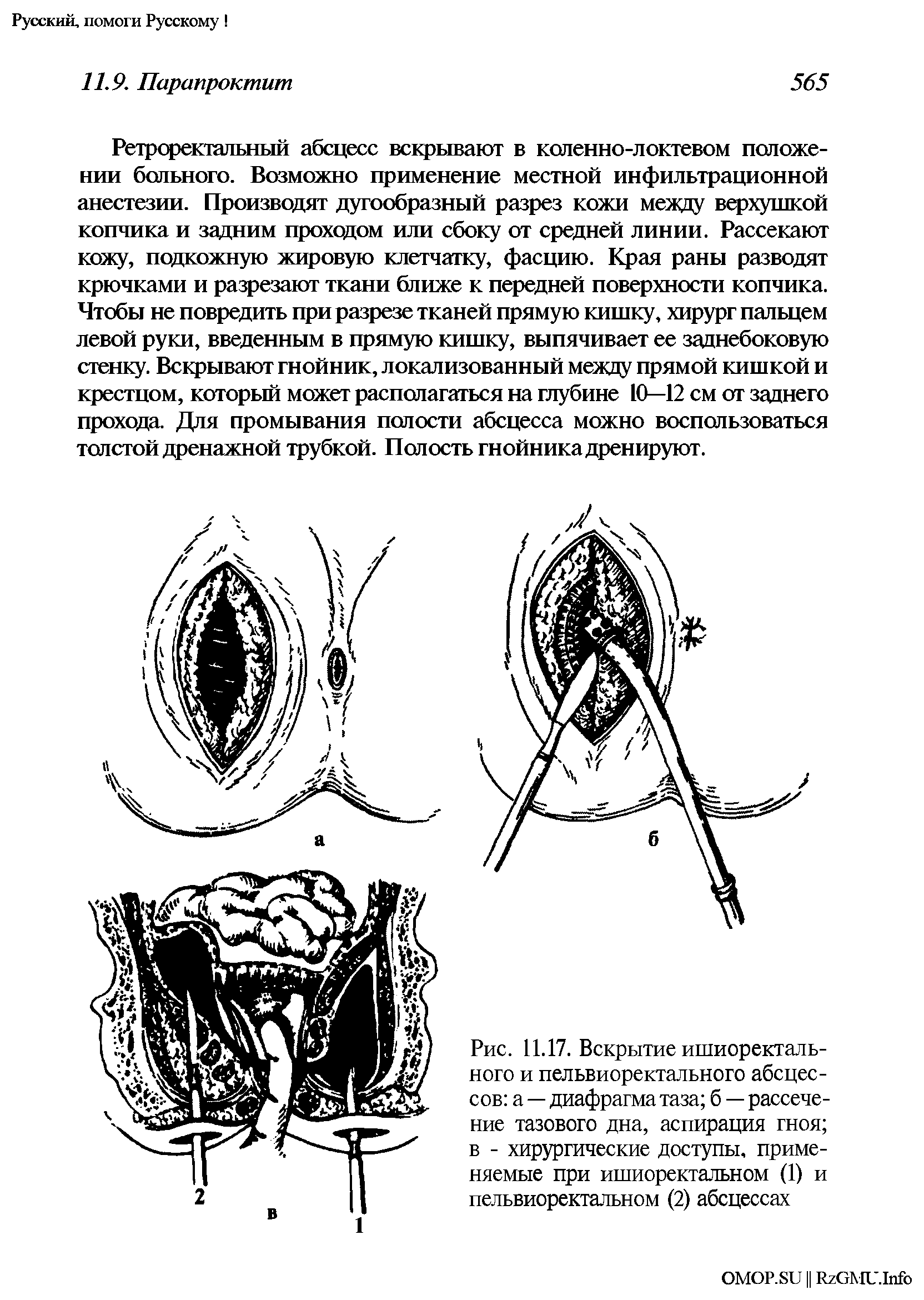 Рис. 11.17. Вскрытие ишиоректального и пельвиоректального абсцессов а — диафрагма таза б — рассечение тазового дна, аспирация гноя в - хирургические доступы, применяемые при ишиоректальном (1) и пельвиоректальном (2) абсцессах...