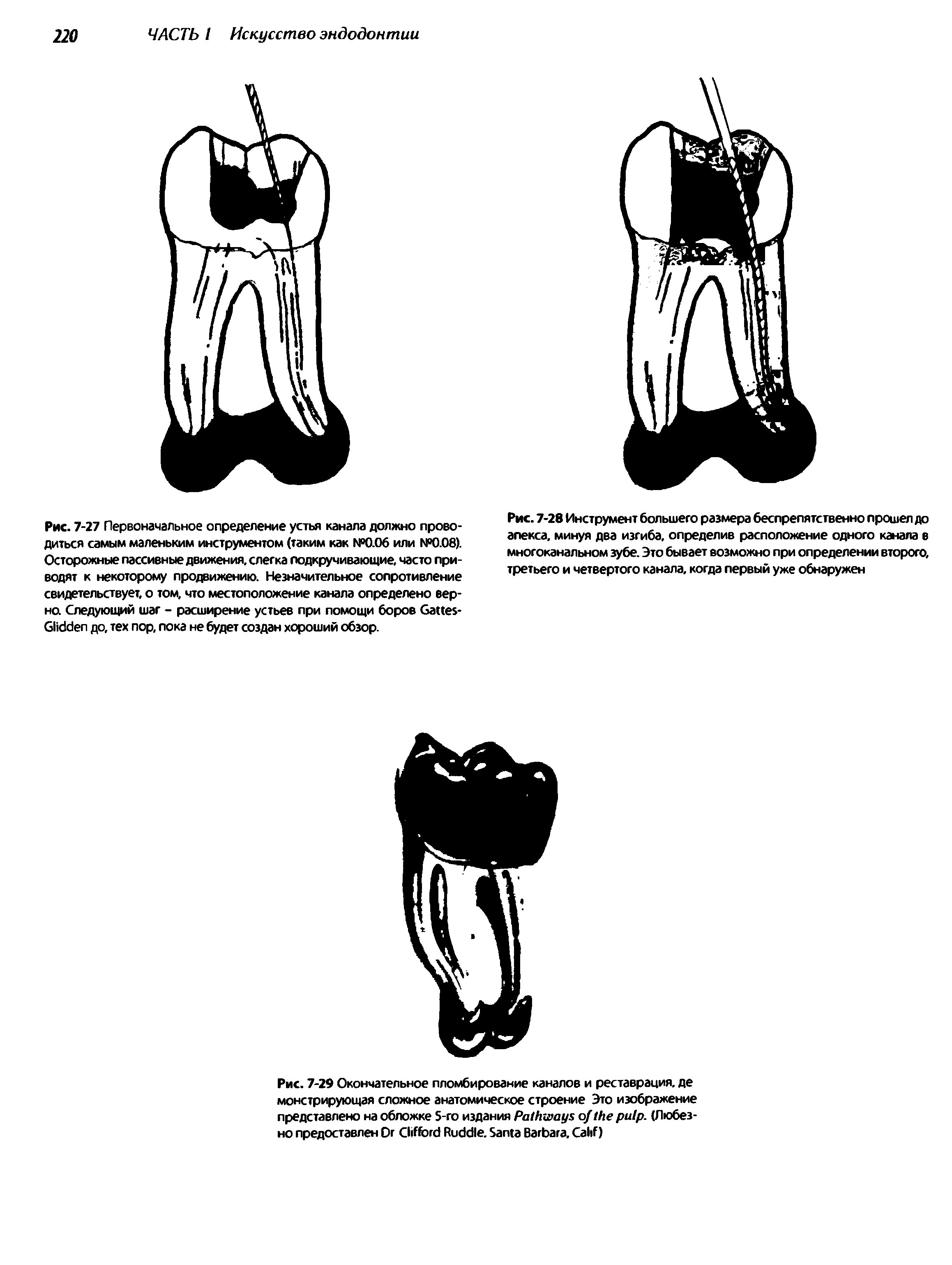 Рис. 7-29 Окончательное пломбирование каналов и реставрация, де монстрирующая сложное анатомическое строение Это изображение представлено на обложке 5-го издания P . (Любезно предоставлен D C R . S B . C )...