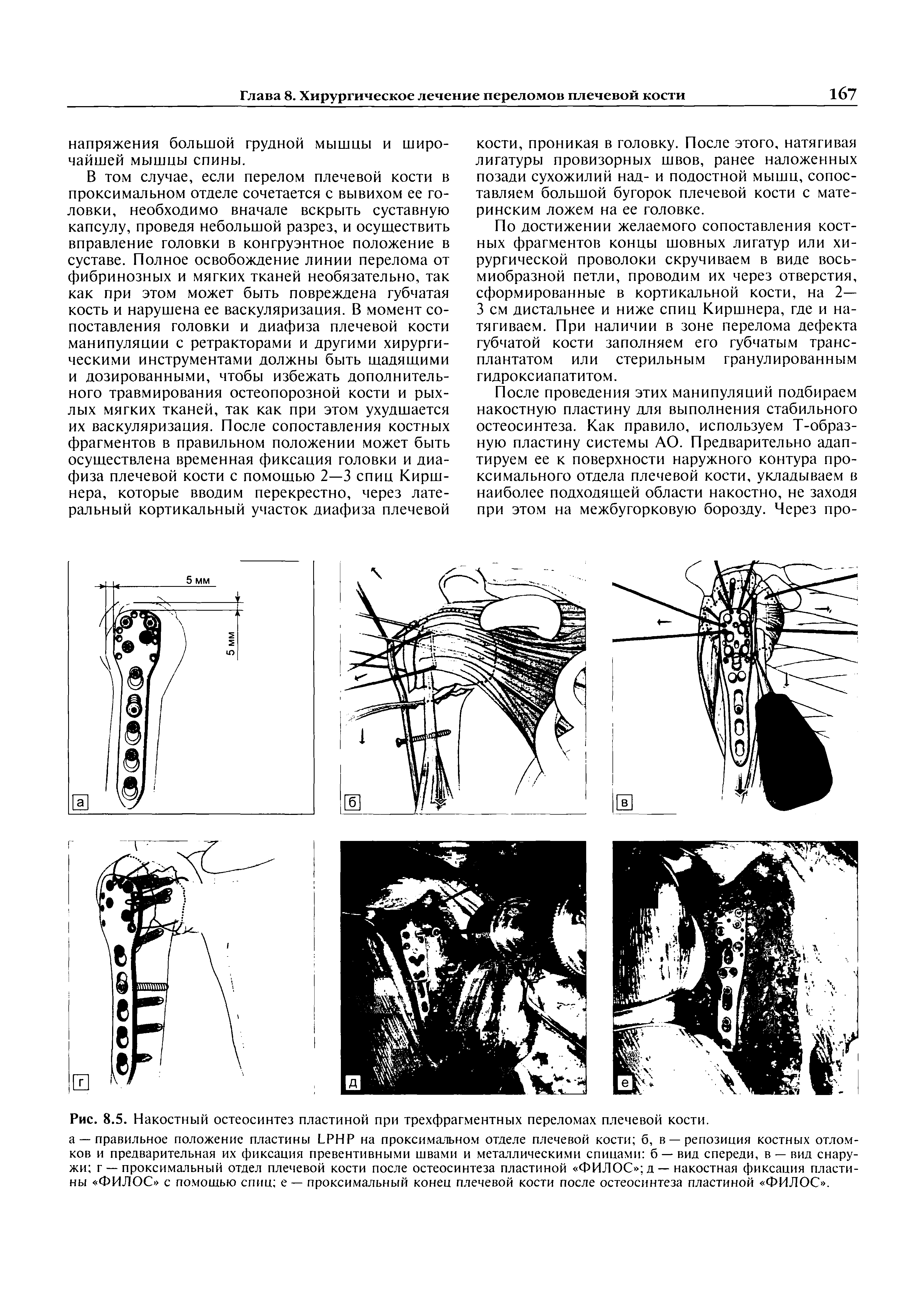 Рис. 8.5. Накостный остеосинтез пластиной при трехфрагментных переломах плечевой кости.