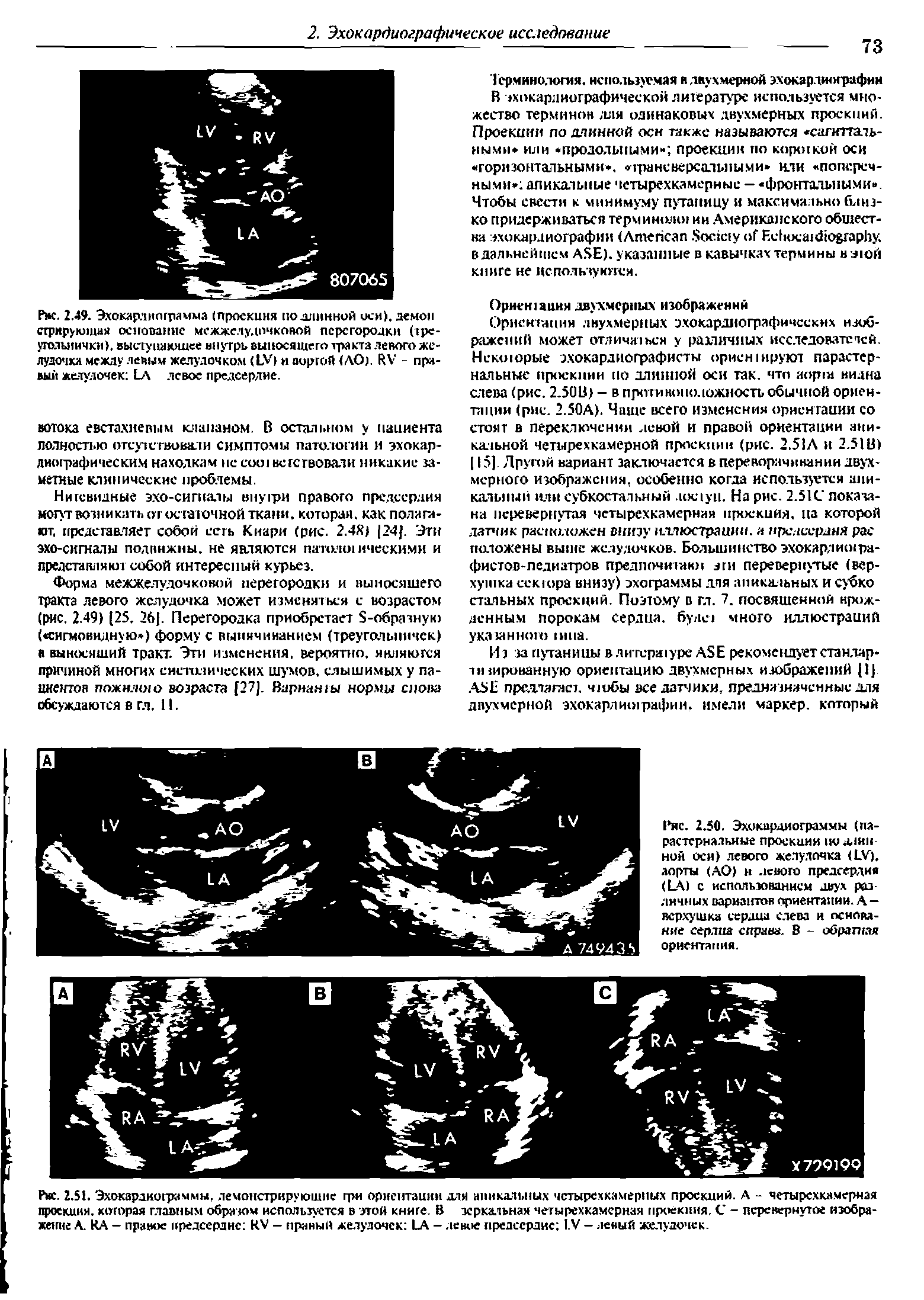 Рис. 2.49. Эхокардиограмма (проекция по длинной оси), демон сгрнрующая основание межжелудочковой перегородки (треугольнички. выступающее внутрь выносящего тракта левого же-луаочка между левым желудочком (1У> и виргой (АО). ИV - правый желудочек 1 А левое предсердие.