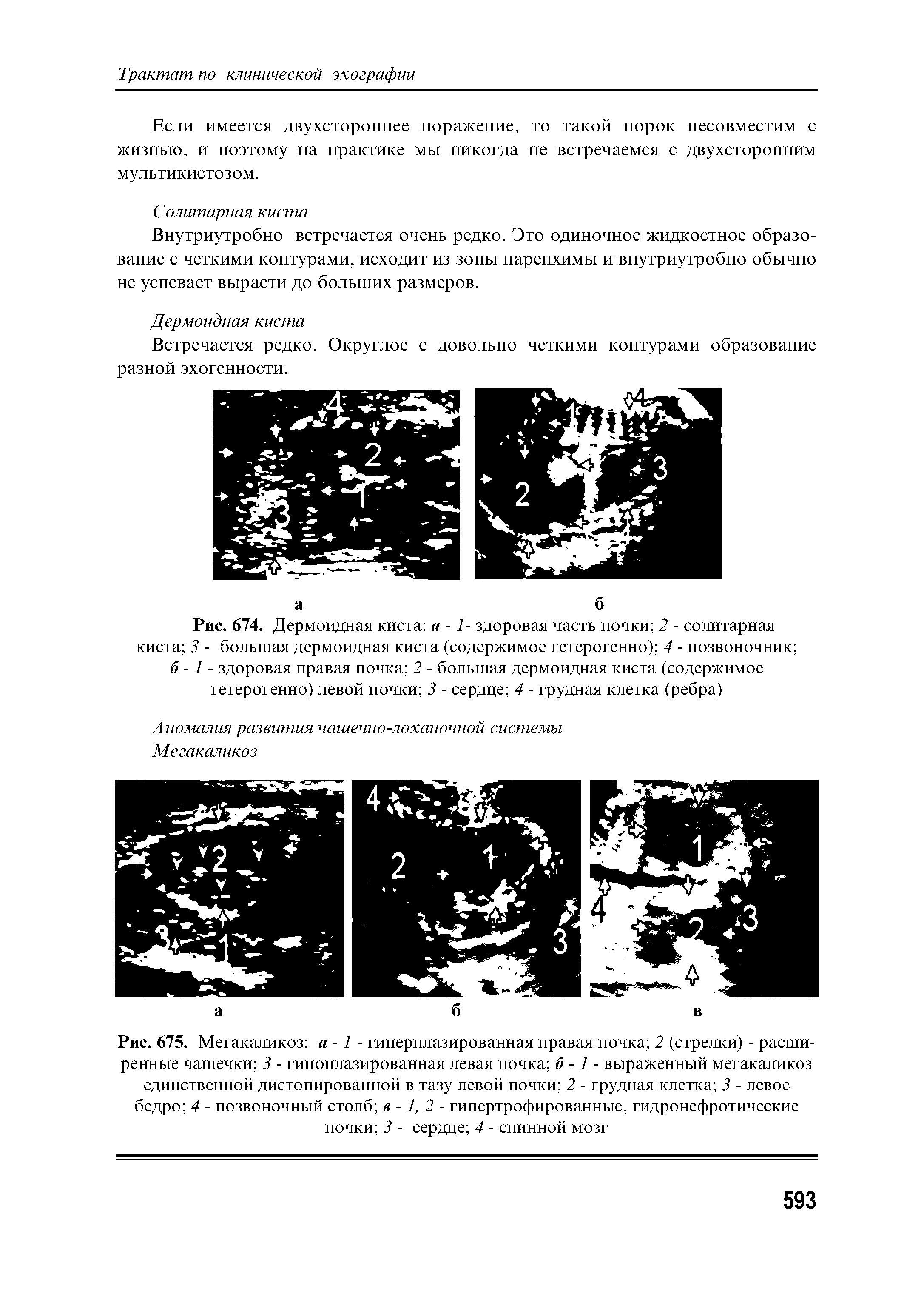 Рис. 674. Дермоидная киста а -1- здоровая часть почки 2 - солитарная киста 3 - большая дермоидная киста (содержимое гетерогенно) 4 - позвоночник ...