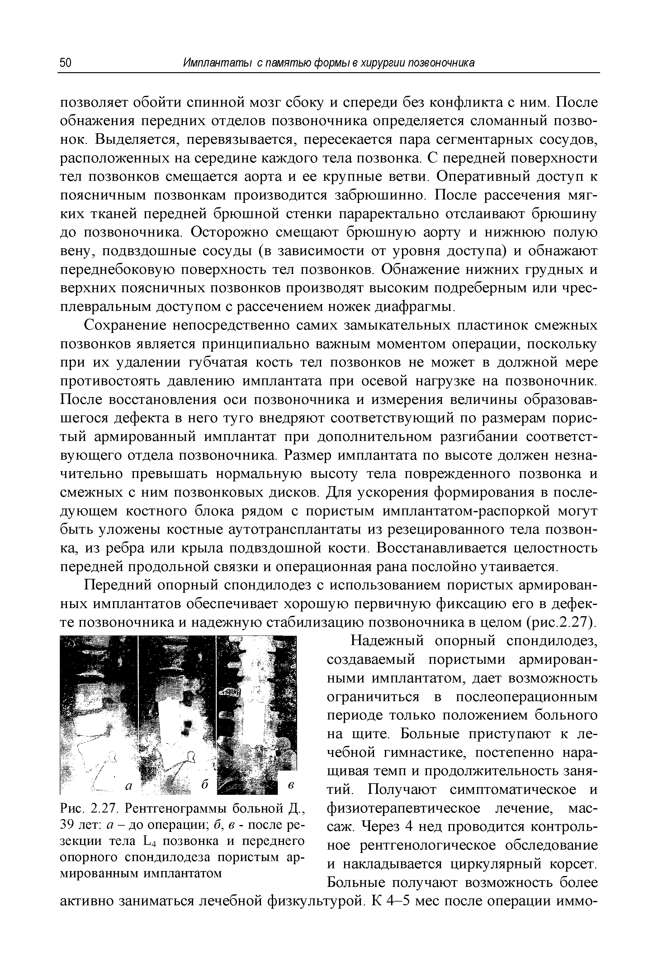 Рис. 2.27. Рентгенограммы больной Д., 39 лет а - до операции б, в - после резекции тела Ь4 позвонка и переднего опорного спондилодеза пористым армированным имплантатом...