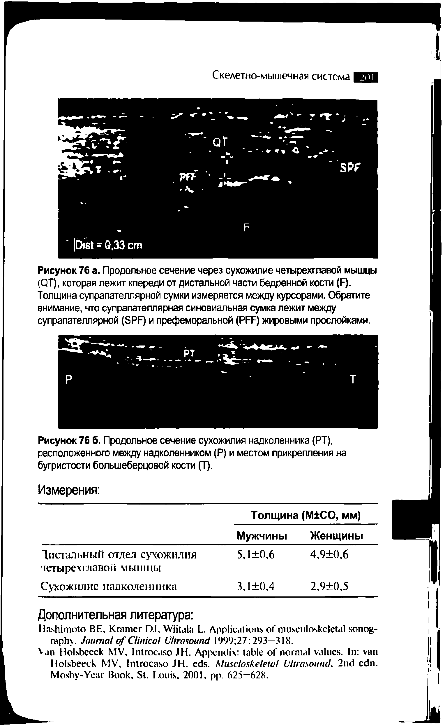 Рисунок 76 6. Продольное сечение сухожилия надколенника (РТ), расположенного между надколенником (Р) и местом прикрепления на бугристости большеберцовой кости (Т).