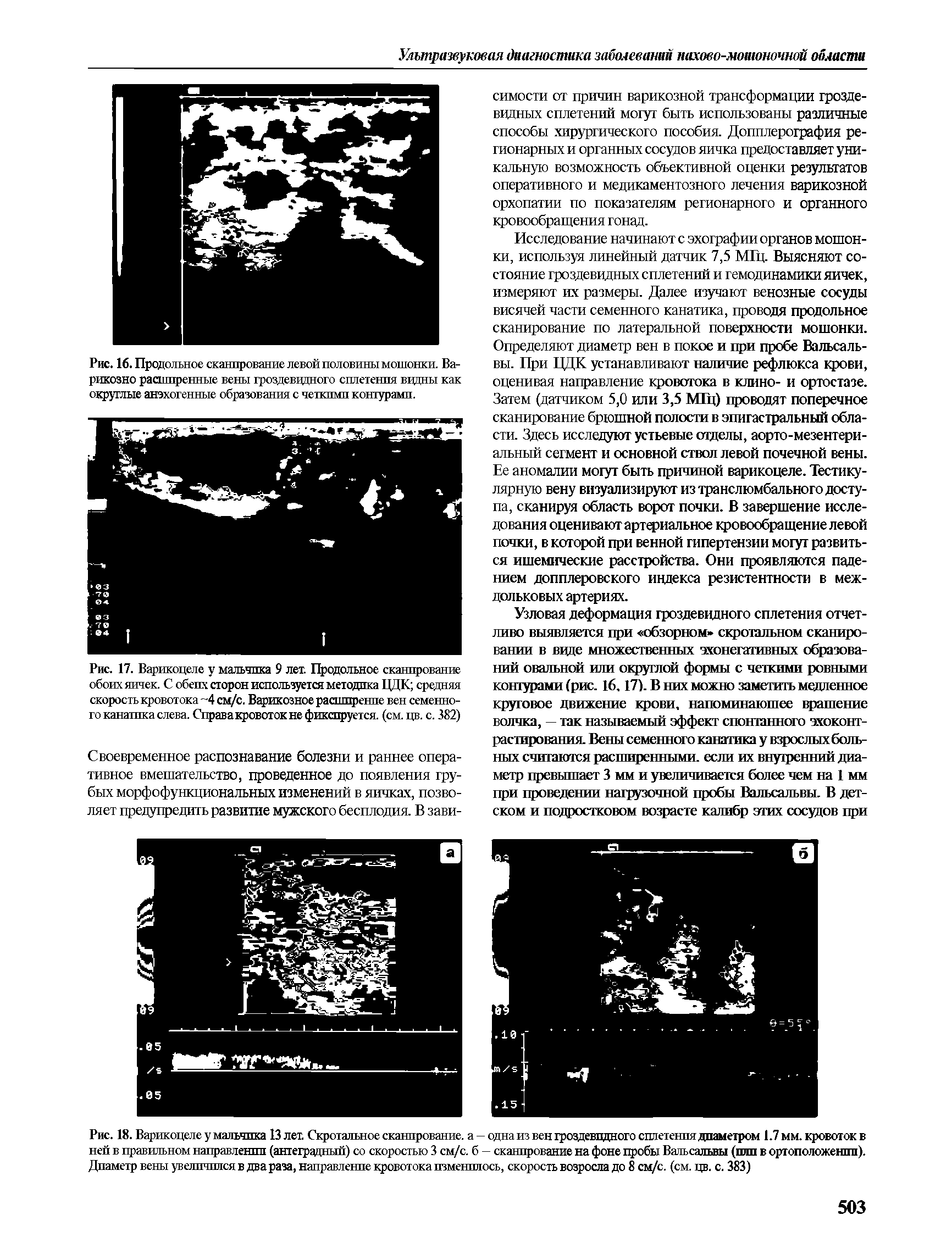 Рис. 17. Варикоцеле у мальчика 9 лет. Продольное сканирование обоих яичек. С обеих сторон используется методика ЦДК средняя скорость кровотока 4 см/с. Варикозное расширение вен семенного канатика слева. Справакровоток не фиксируется, (см. цв. с. 382)...