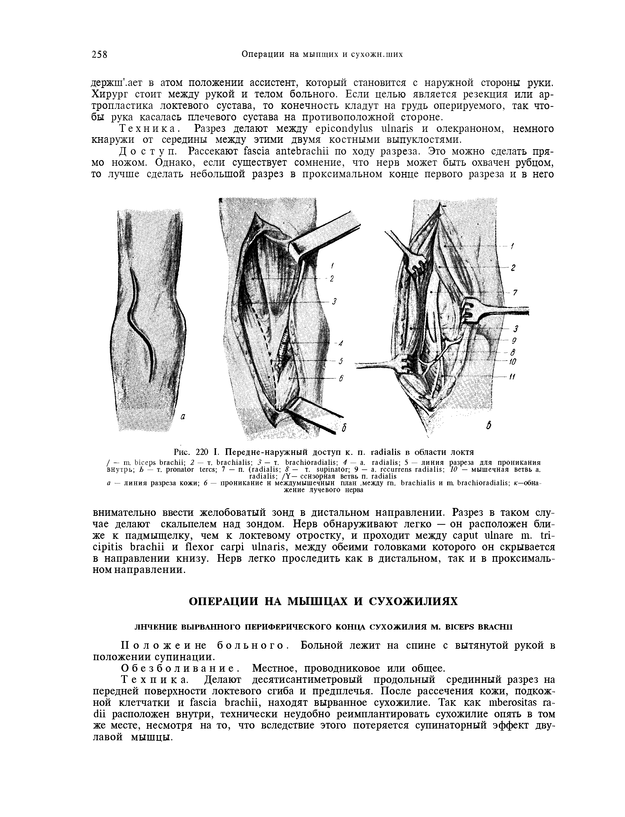 Рис. 220 I. Передне-наружный доступ к. п. в области локтя...