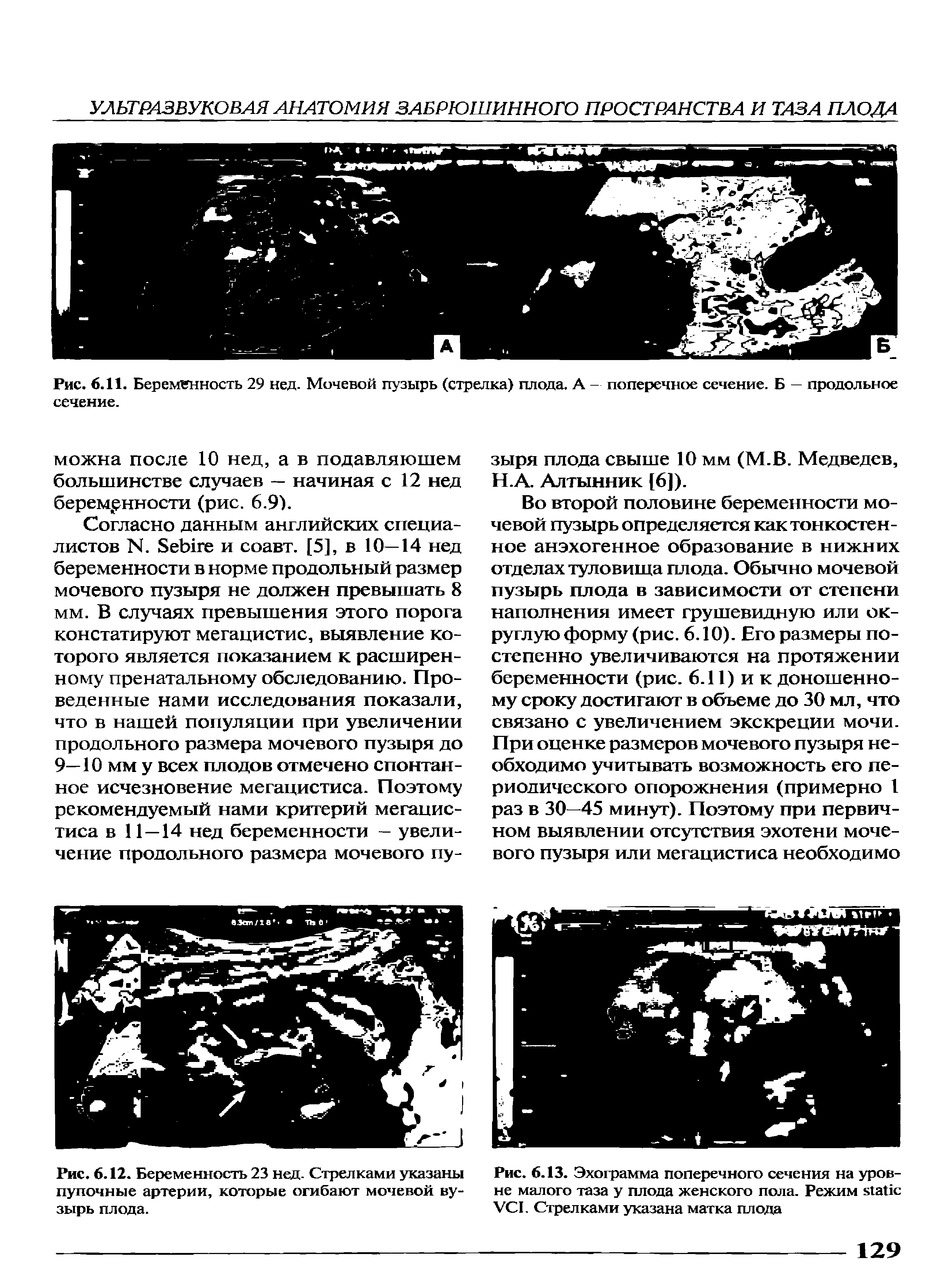 Рис. 6.12. Беременность 23 нед. Стрелками указаны пупочные артерии, которые огибают мочевой ву-зырь плода.