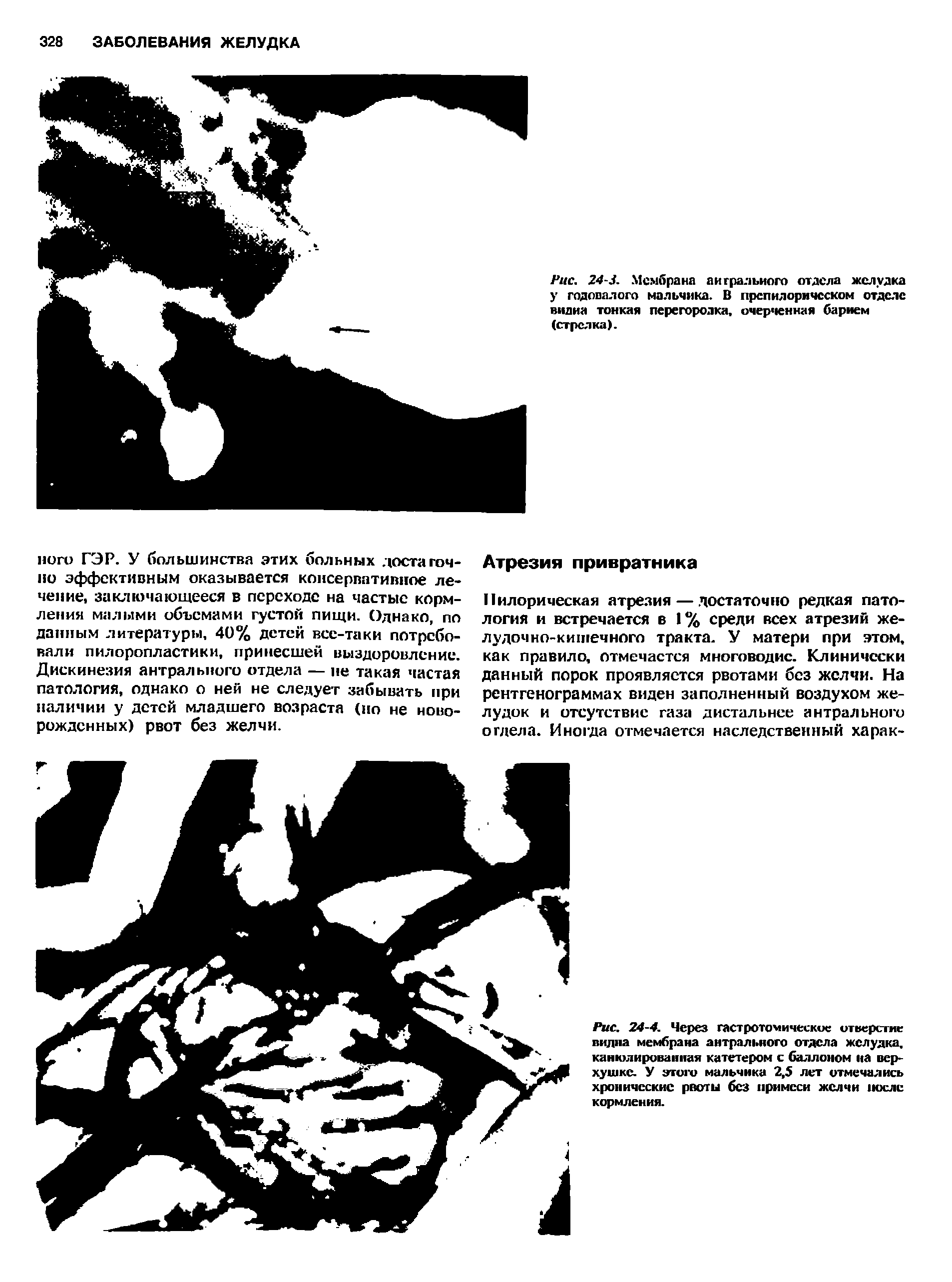 Рис. 24-4. Через гастротомическис отверстие видна мембрана антрального отдела желудка, канюлированная катетером с баллоном на верхушке. У этого мальчика 2,5 лет отмечались хронические рвоты без примеси желчи после кормления.