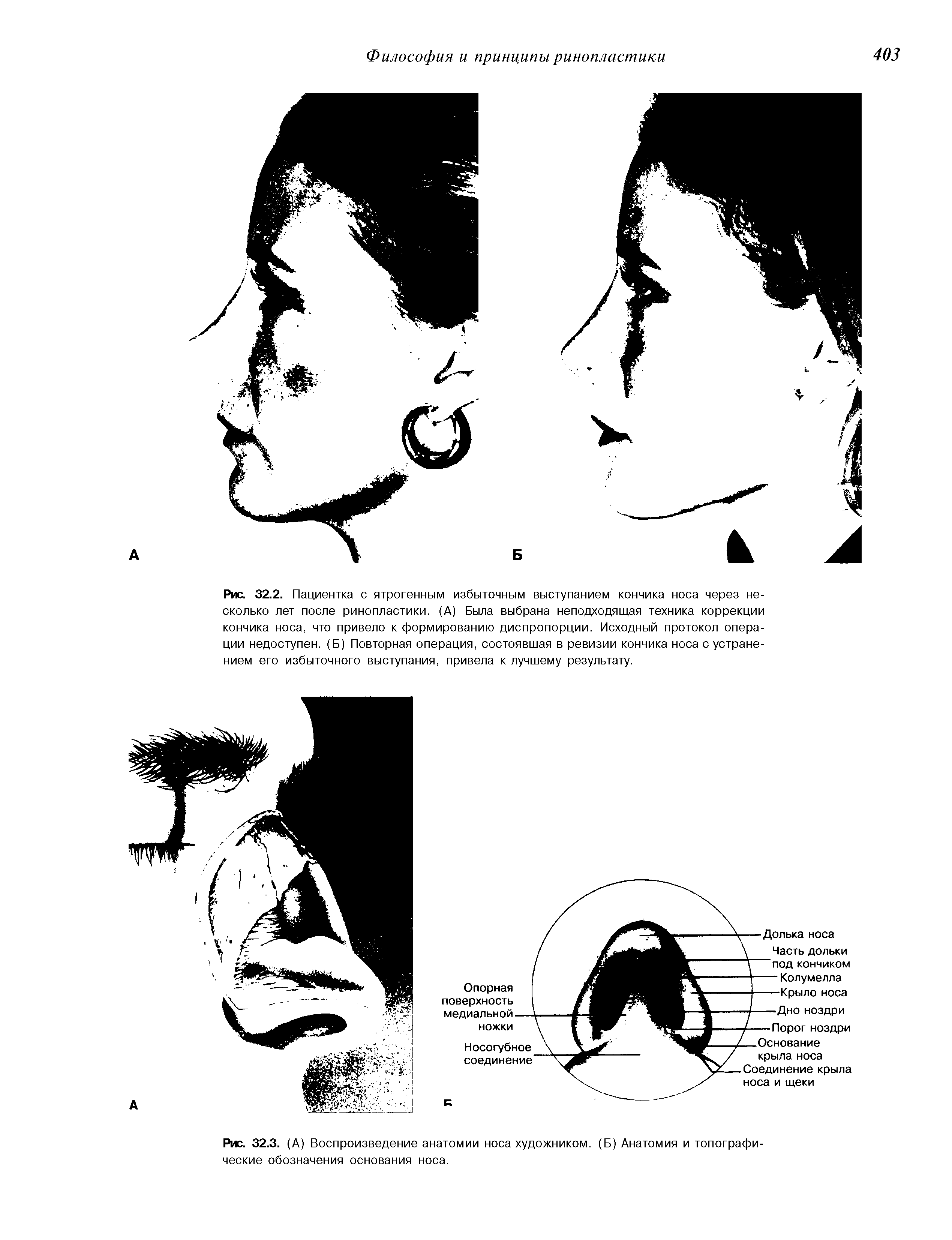 Рис. 32.3. (А) Воспроизведение анатомии носа художником. (Б) Анатомия и топографические обозначения основания носа.