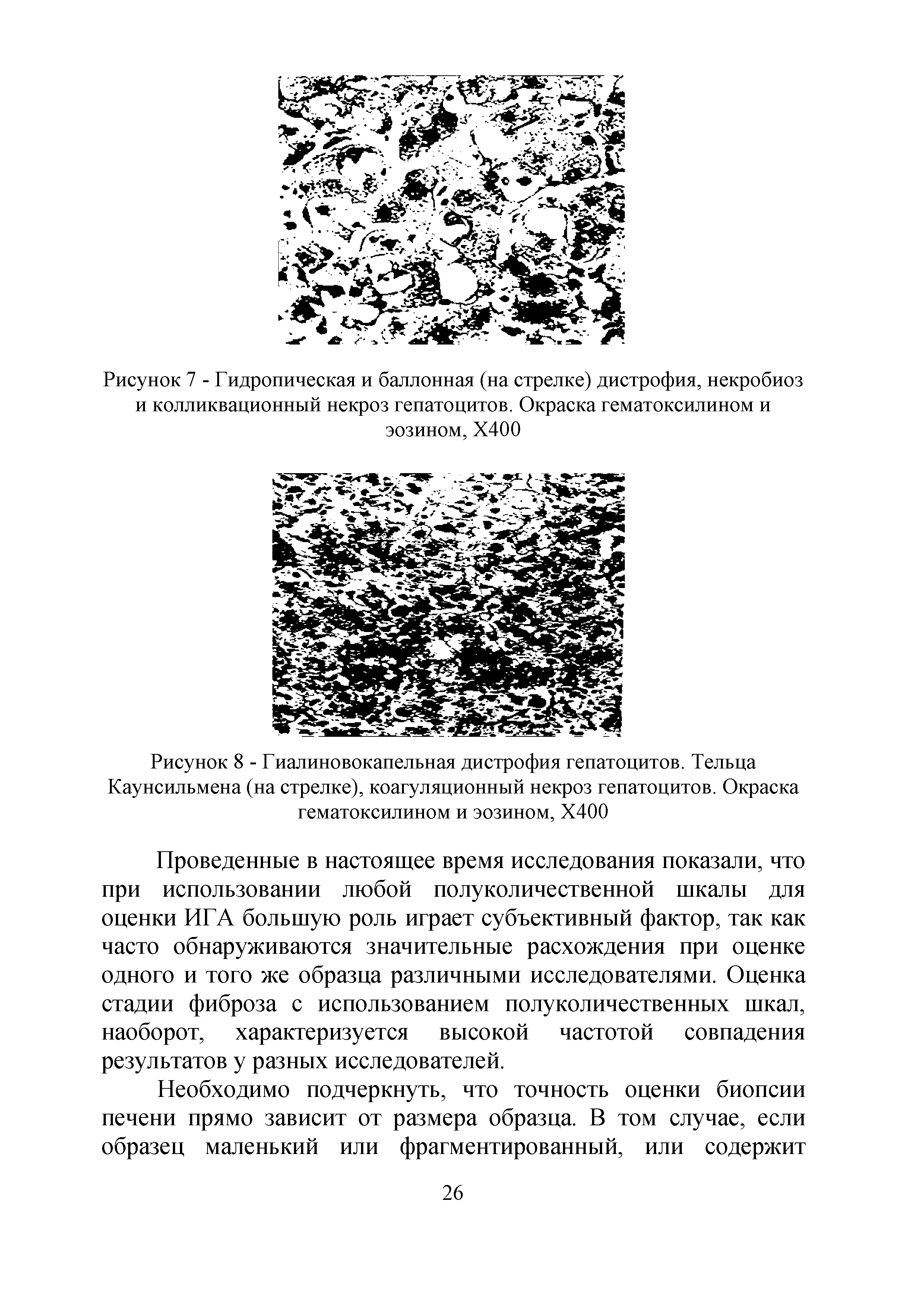 Рисунок 8 - Гиалиновокапельная дистрофия гепатоцитов. Тельца Каунсильмена (на стрелке), коагуляционный некроз гепатоцитов. Окраска гематоксилином и эозином, Х400...