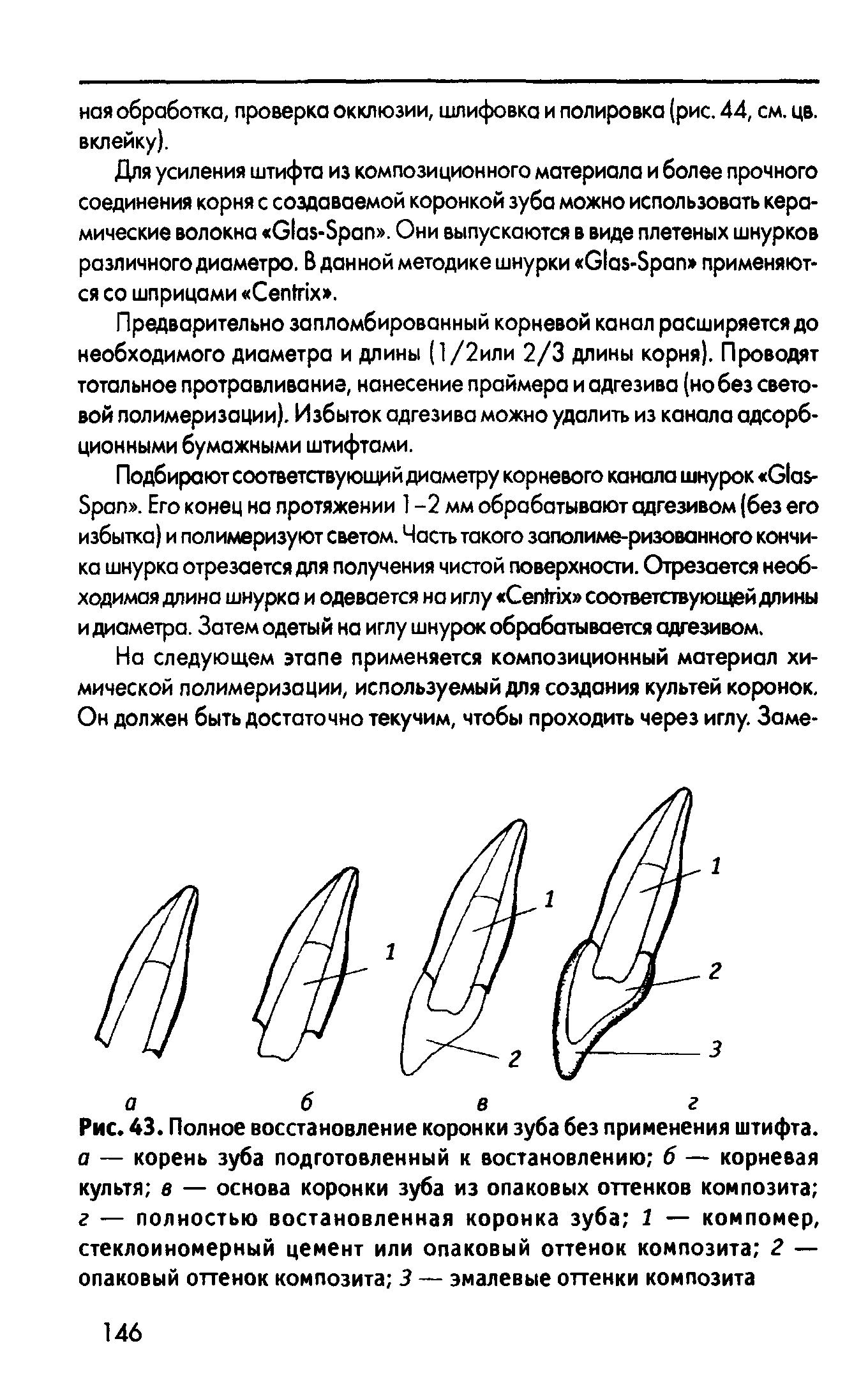 Рис. 43. Полное восстановление коронки зуба без применения штифта, г — корень зуба подготовленный к востановлению 6 — корневая культя в — основа коронки зуба из опаковых оттенков композита г — полностью востановленная коронка зуба 1 — компомер, стеклоиномерный цемент или опаковый оттенок композита 2 — опаковый оттенок композита 3 — эмалевые оттенки композита...