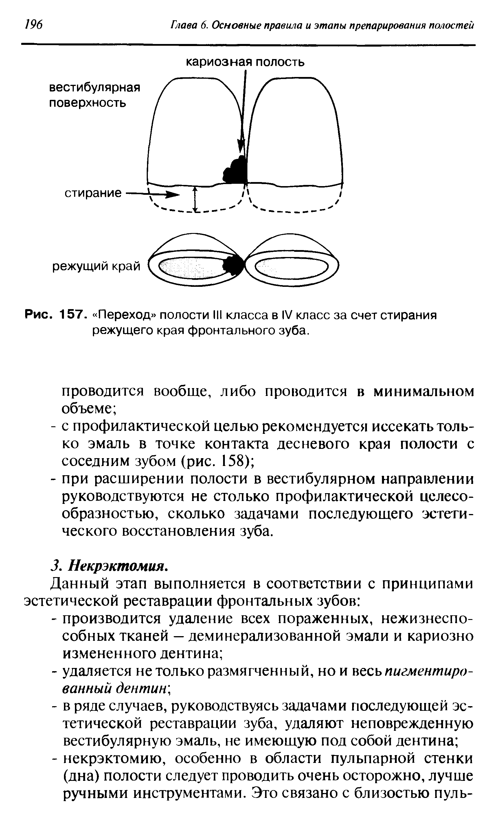 Рис. 157. Переход полости III класса в IV класс за счет стирания режущего края фронтального зуба.