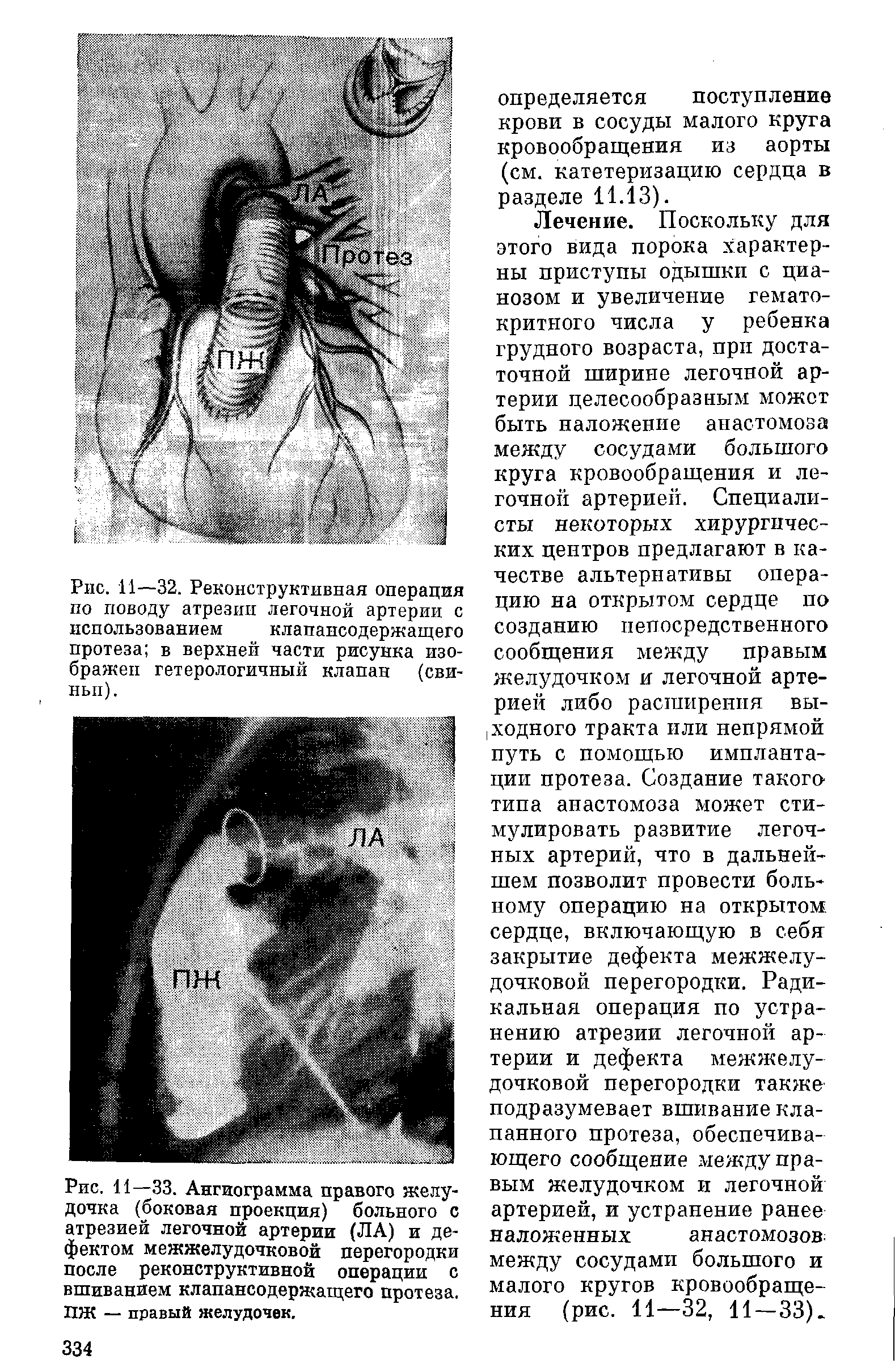 Рис. 11—33. Ангиограмма правого желудочка (боковая проекция) больного с атрезией легочной артерии (ЛА) и дефектом межжелудочковой перегородки после реконструктивной операции с вшиванием клапансодержащего протеза. ПЖ — правый желудочек.