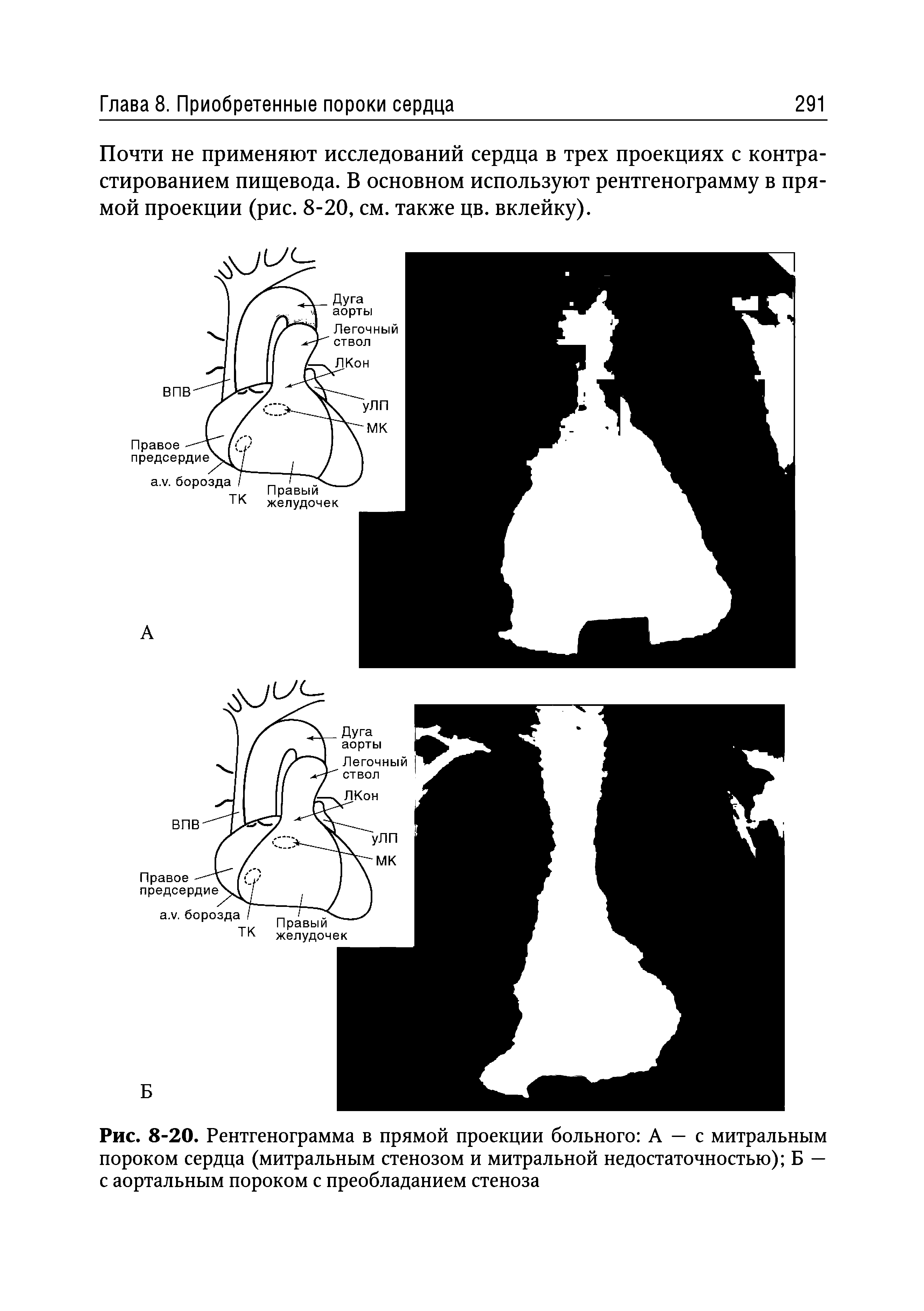 Рис. 8-20. Рентгенограмма в прямой проекции больного А — с митральным пороком сердца (митральным стенозом и митральной недостаточностью) Б — с аортальным пороком с преобладанием стеноза...