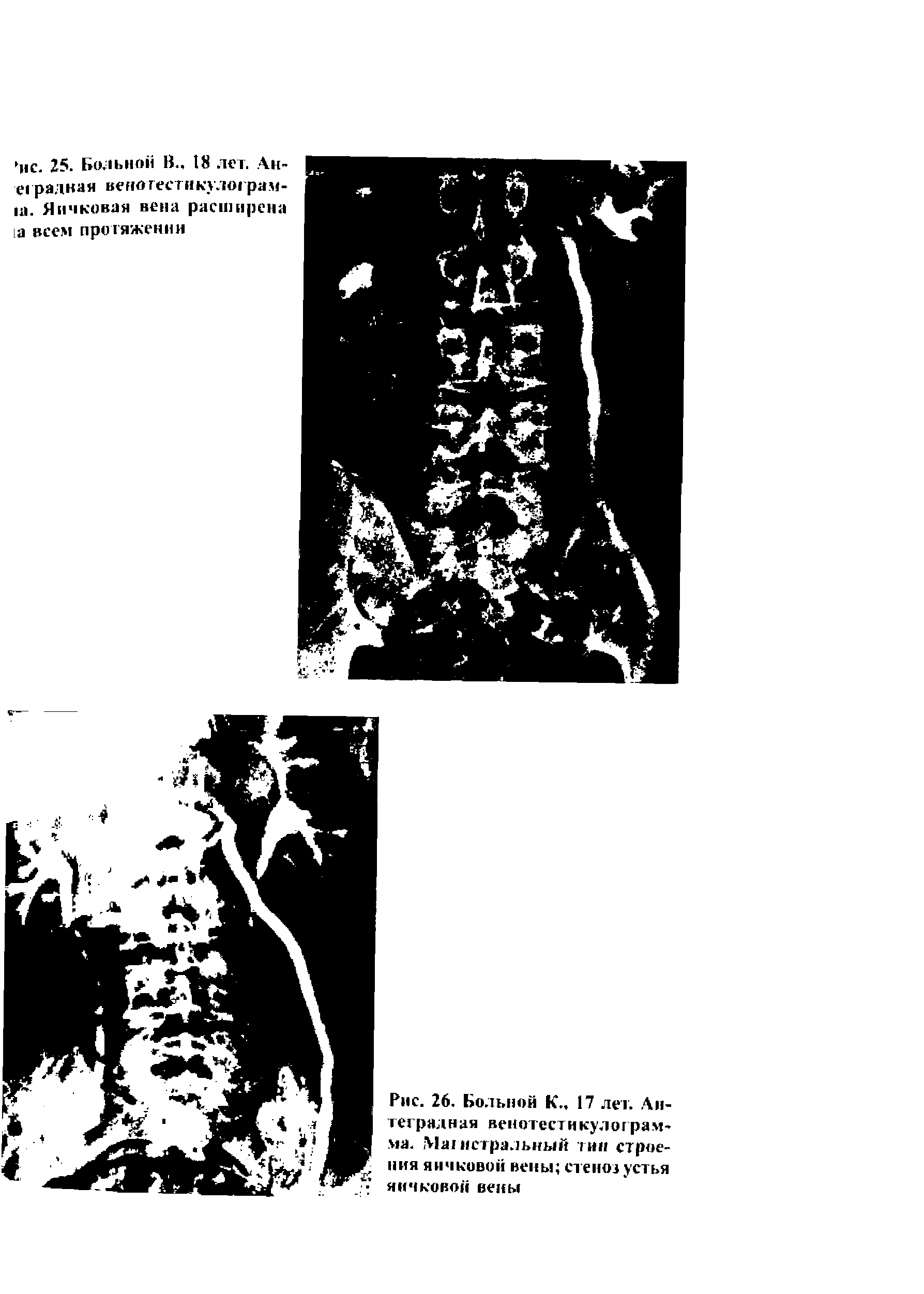 Рис. 26. Больной К., 17 лет. Антеградная веиотестнкулограм-ма. M истральный тип строения яичковой вены стеноз устья яичковой вены...