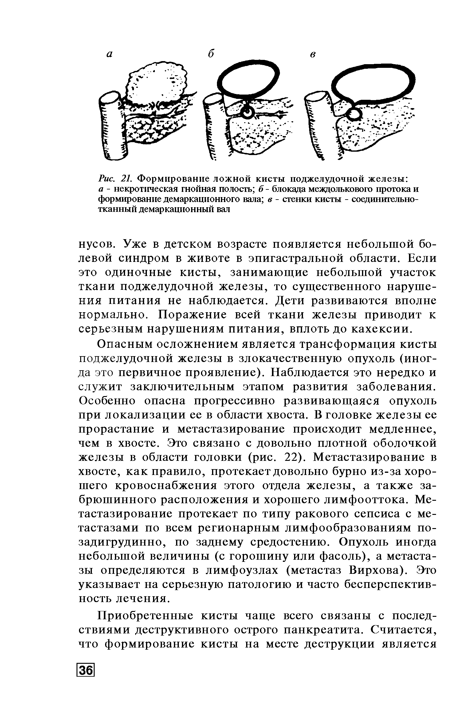 Рис. 21. Формирование ложной кисты поджелудочной железы а - некротическая гнойная полость б - блокада междолькового протока и формирование демаркационного вала в - стенки кисты - соединительнотканный демаркационный вал...