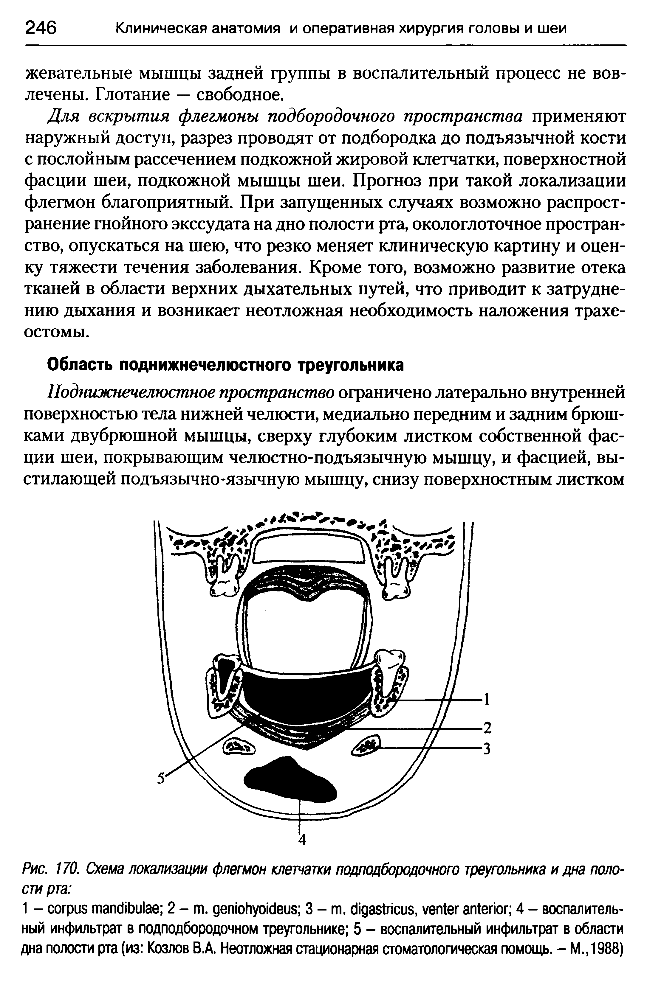 Рис. 170. Схема локализации флегмон клетчатки подподбородочного треугольника и дна полости рта ...