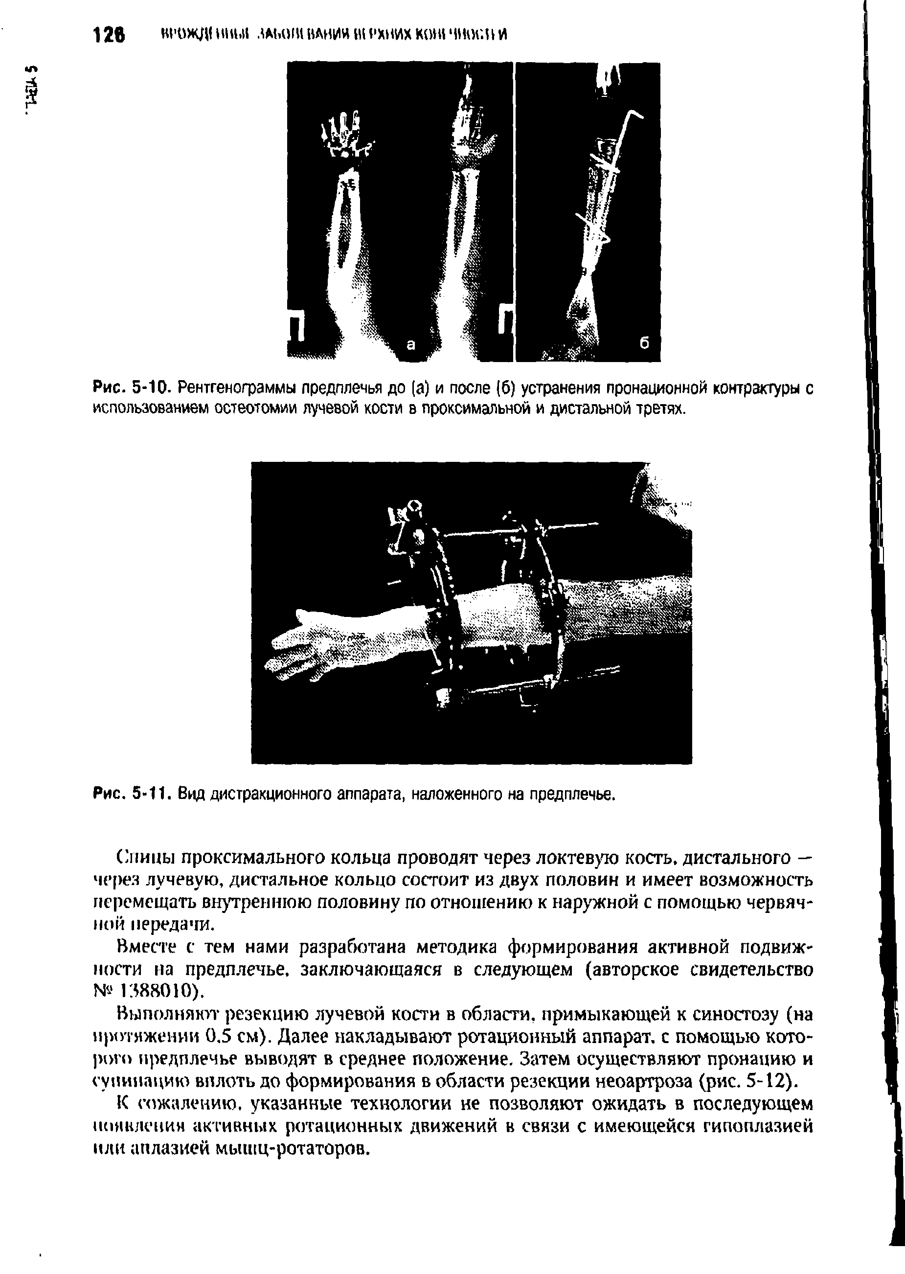 Рис. 5-10. Рентгенограммы предплечья до (а) и после (б) устранения пронационной контрактуры с использованием остеотомии лучевой кости в проксимальной и дистальной третях.