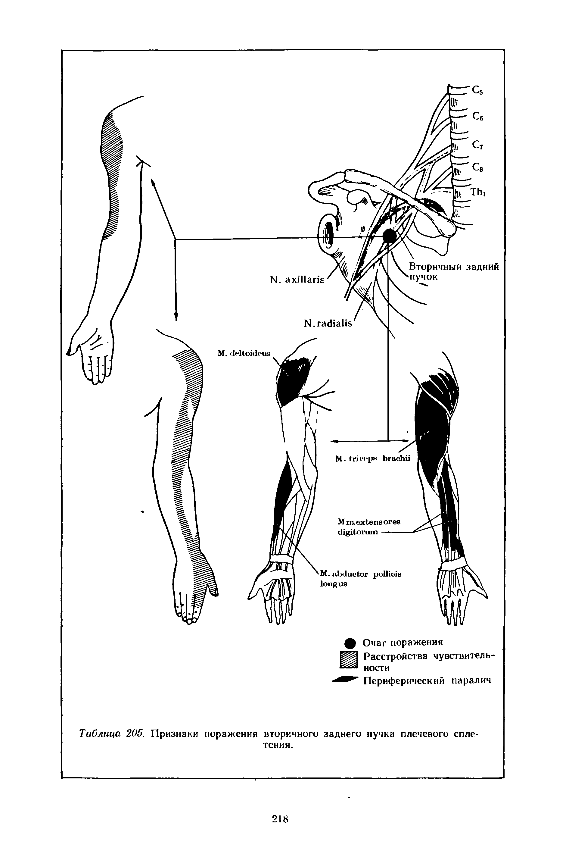 Таблица 205. Признаки поражения вторичного заднего пучка плечевого сплетения.
