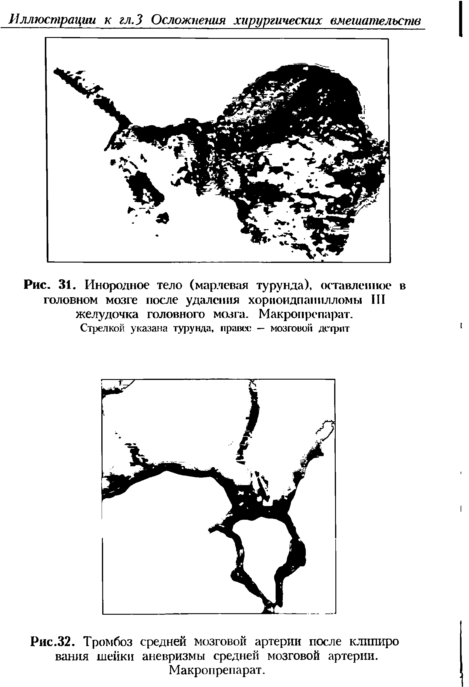 Рис. 31. Инородное тело (марлевая турунда), оставленное в головном мозге после удаления хориоидпапилломы III желудочка головного мозга. Макропрепарат.