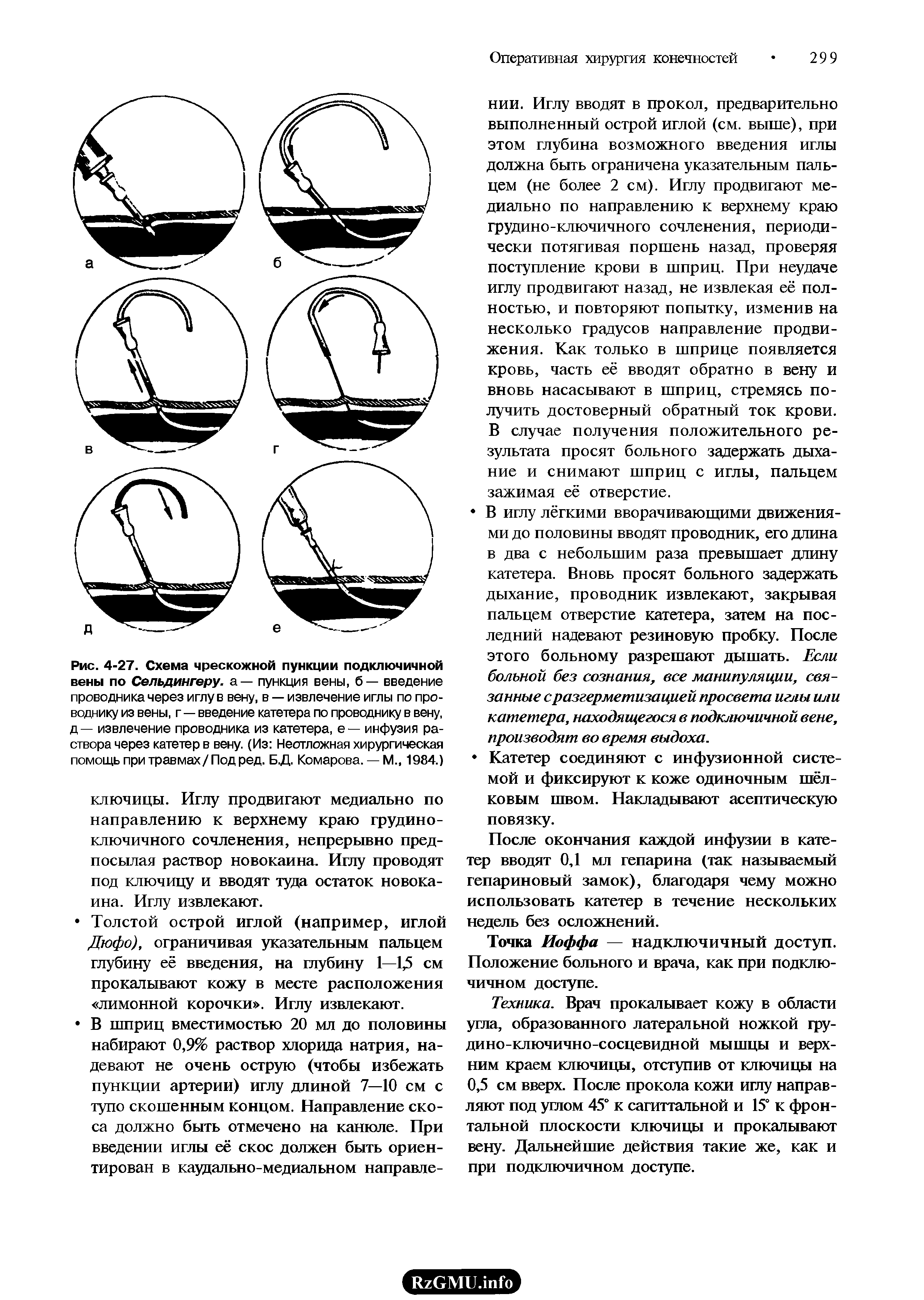 Рис. 4-27. Схема чрескожной пункции подключичной вены по Сельдингеру. а — пункция вены, б — введение проводника через иглу в вену, в — извлечение иглы по проводнику из вены, г—введение катетера по проводнику в вену, д— извлечение проводника из катетера, е— инфузия раствора через катетер в вену. (Из Неотложная хирургическая помощь при травмах/ Под ред. Б.Д. Комарова. — М., 1984.)...