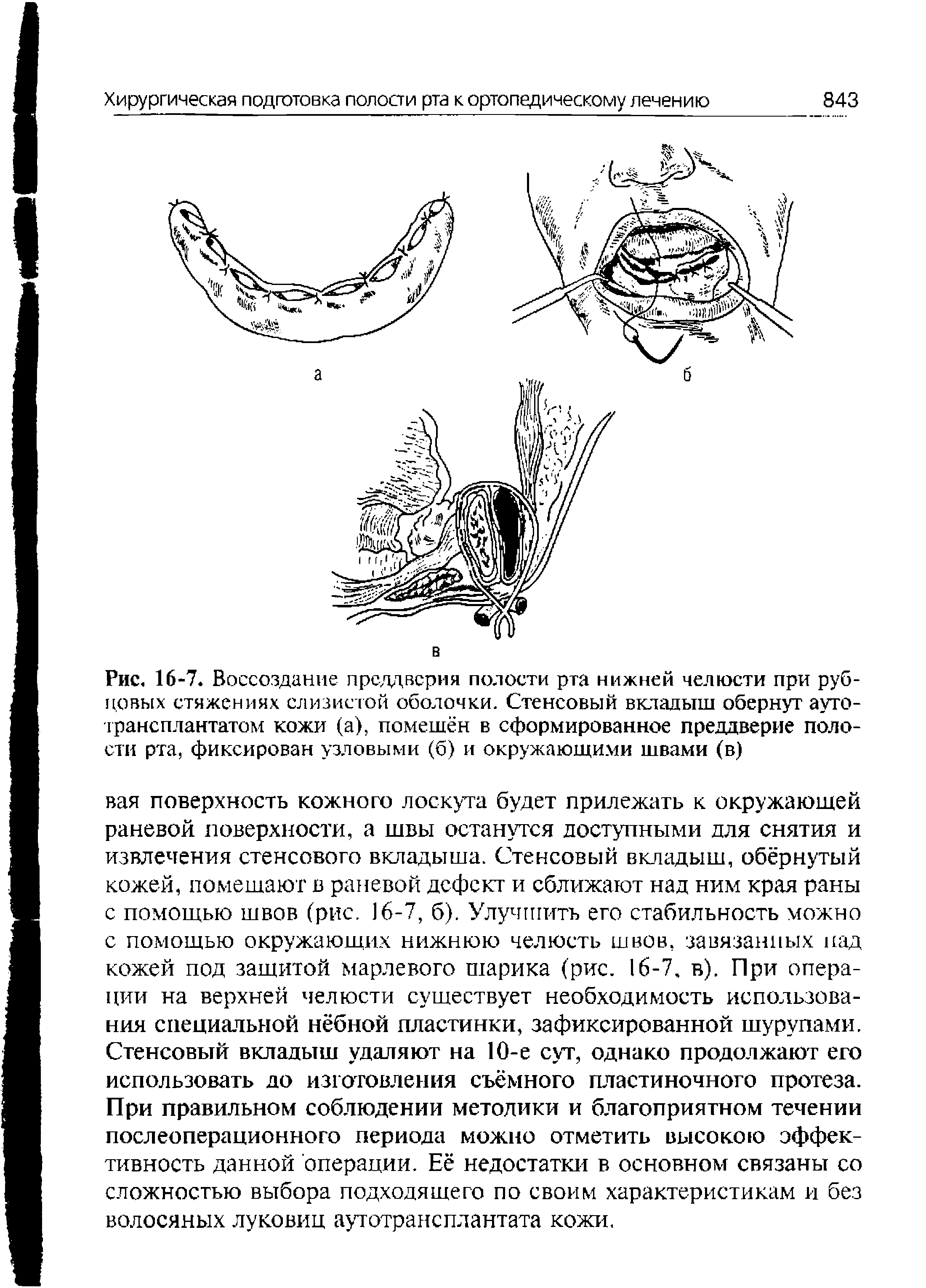 Рис. 16-7. Воссоздание преддверия полости рта нижней челюсти при рубцовых стяжениях слизистой оболочки. Стенсовый вкладыш обернут аутотрансплантатом кожи (а), помешен в сформированное преддверие полости рта, фиксирован узловыми (б) и окружающими швами (в)...
