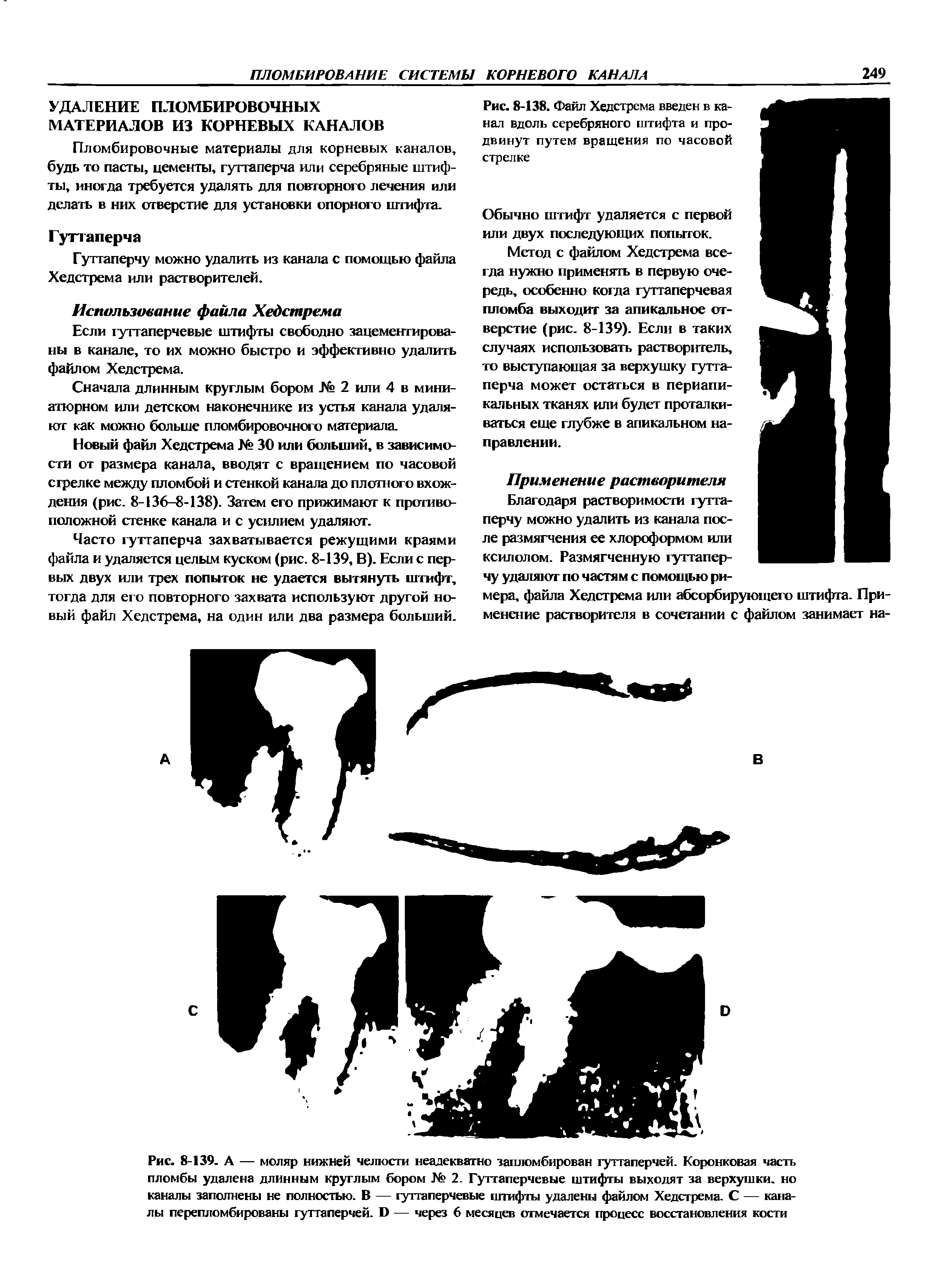 Рис. 8-138. Файл Хедстрема введен в канал вдоль серебряного штифта и продвинут путем вращения по часовой стрелке...