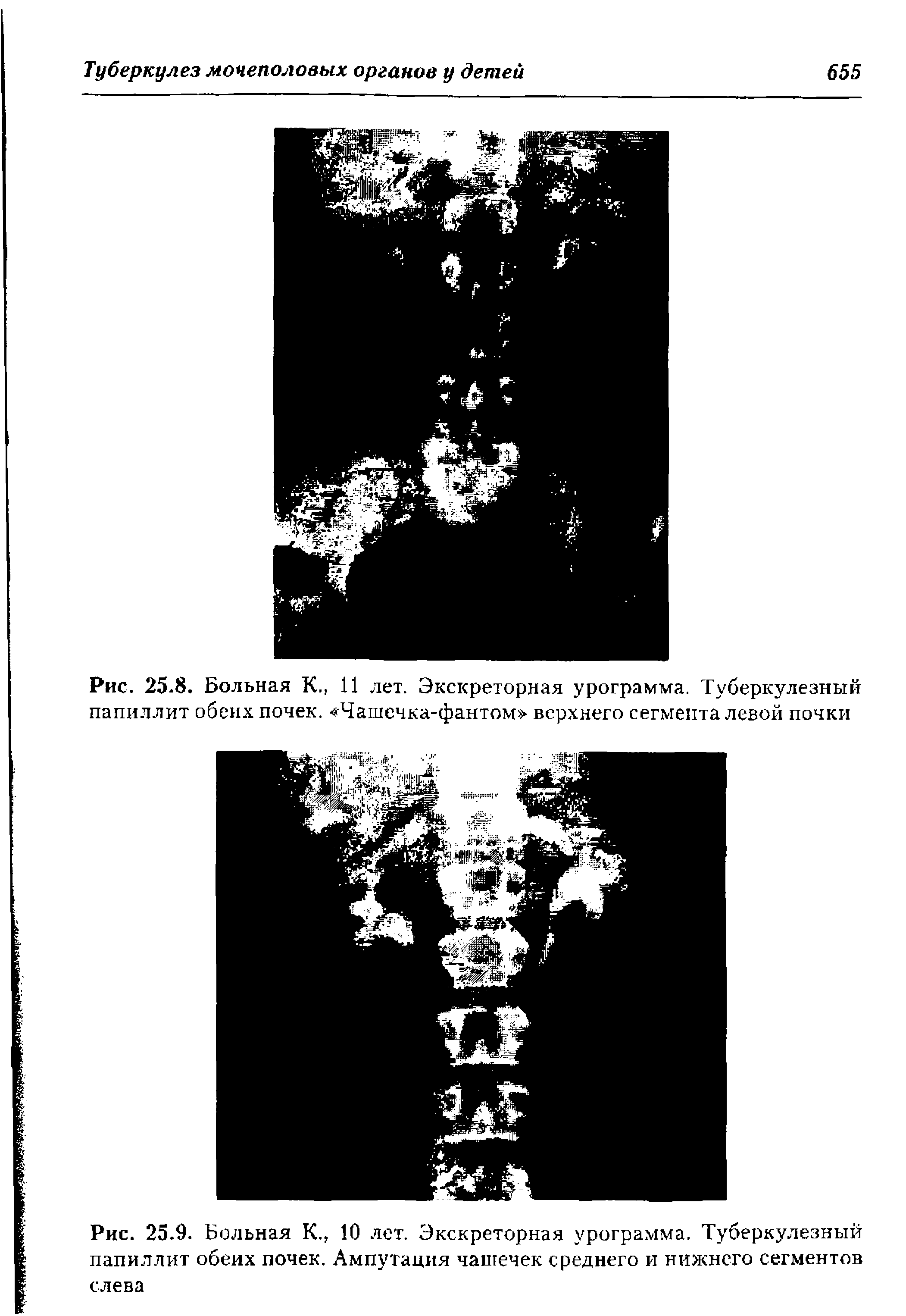 Рис. 25.9. Больная К., 10 лет. Экскреторная урограмма. Туберкулезный папиллит обеих почек. Ампутация чашечек среднего и нижнего сегментов слева...
