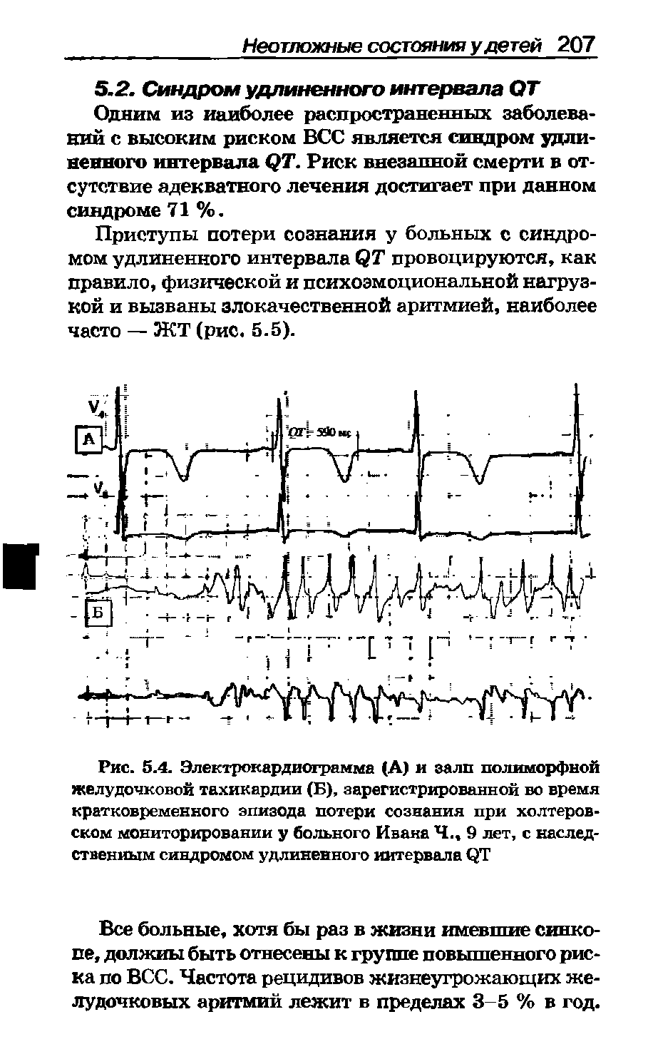 Рис. 5.4. Электрокардиограмма (А) и залп полиморфной желудочковой тахикардии (Б), зарегистрированной во время кратковременного эпизода потери сознания при холтеровском мониторировании у больного Ивана Ч., 9 лет, с наследственным синдромом удлиненного интервала...