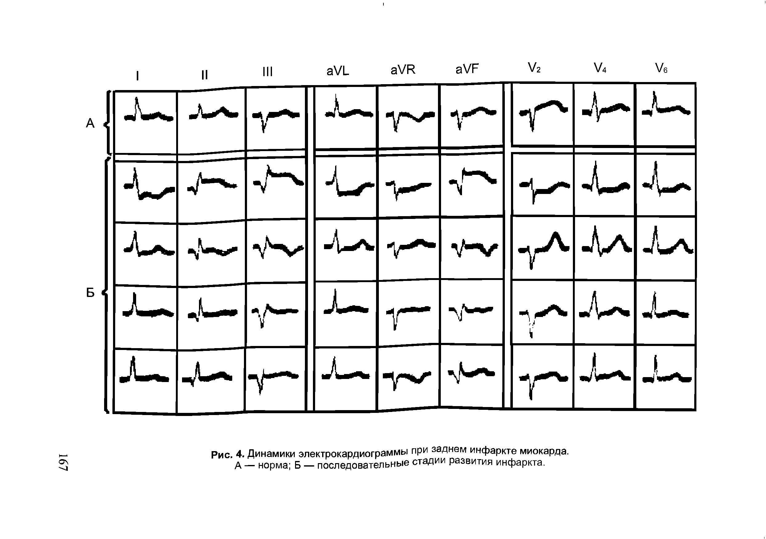 Рис. 4. Динамики электрокардиограммы при заднем инфаркте миокарда. А — норма Б — последовательные стадии развития инфаркта.