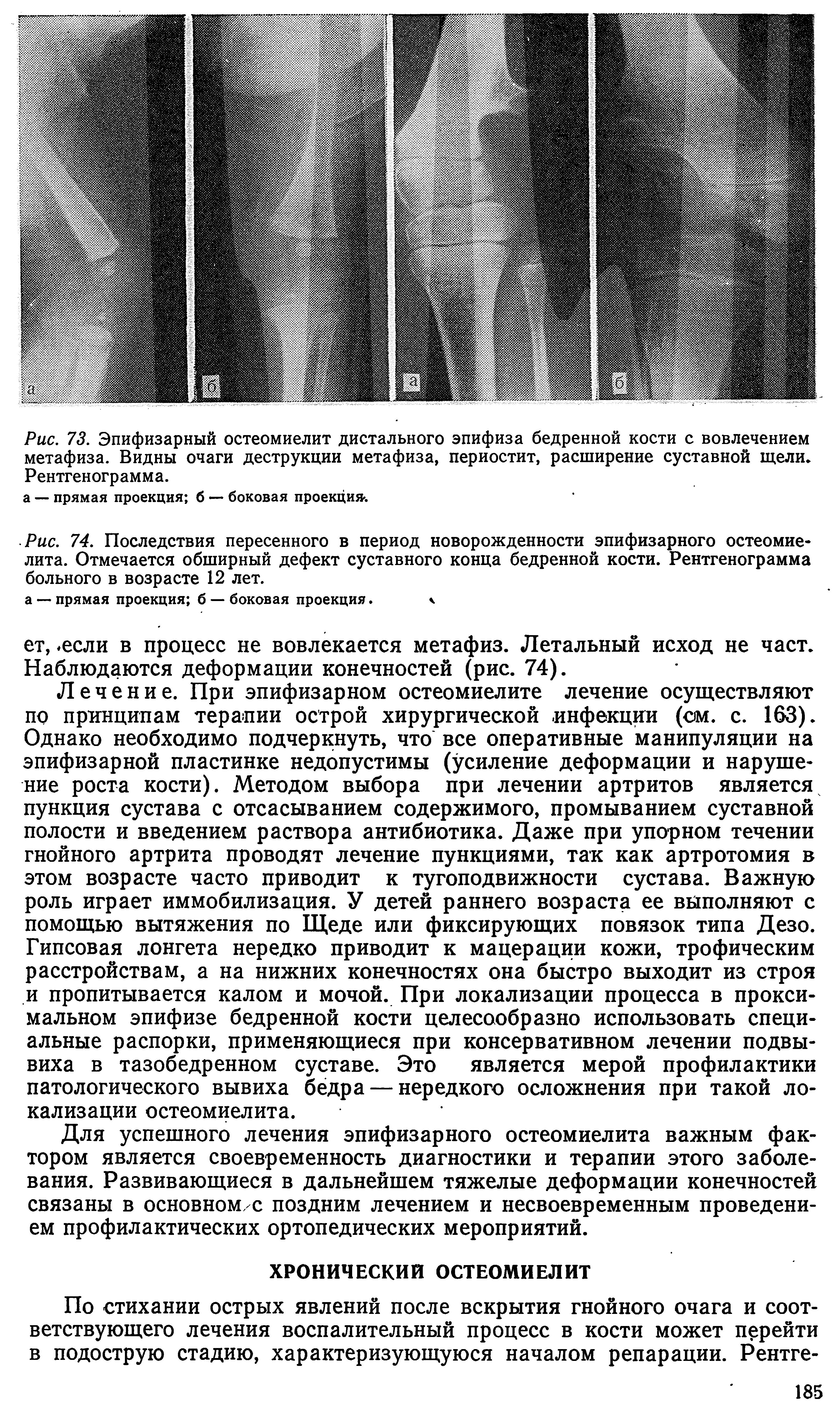 Рис. 74. Последствия пересенного в период новорожденности эпифизарного остеомиелита. Отмечается обширный дефект суставного конца бедренной кости. Рентгенограмма больного в возрасте 12 лет.