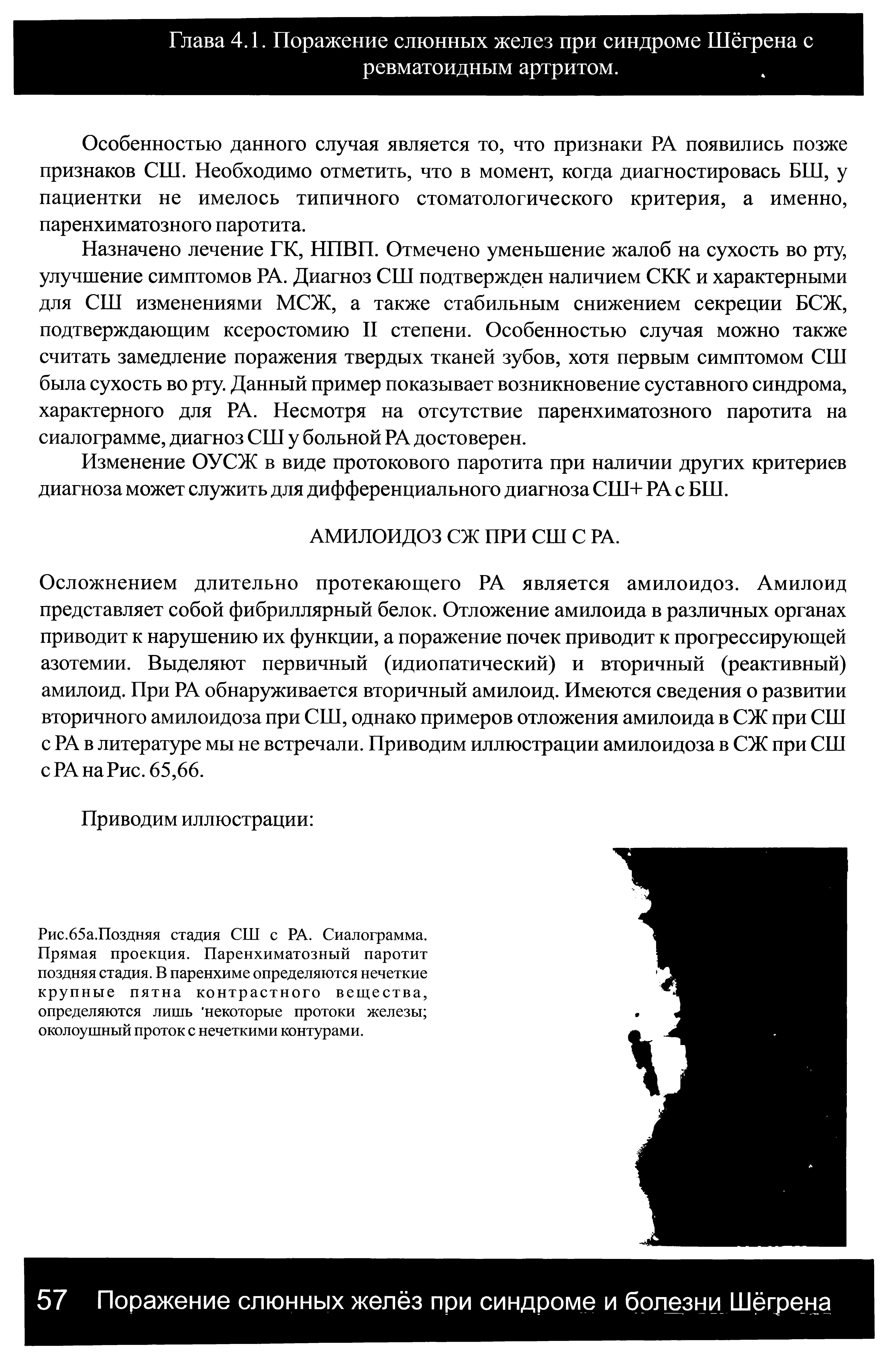 Рис.65а.Поздняя стадия СШ с РА. Сиалограмма. Прямая проекция. Паренхиматозный паротит поздняя стадия. В паренхиме определяются нечеткие крупные пятна контрастного вещества, определяются лишь некоторые протоки железы околоушный проток с нечеткими контурами.