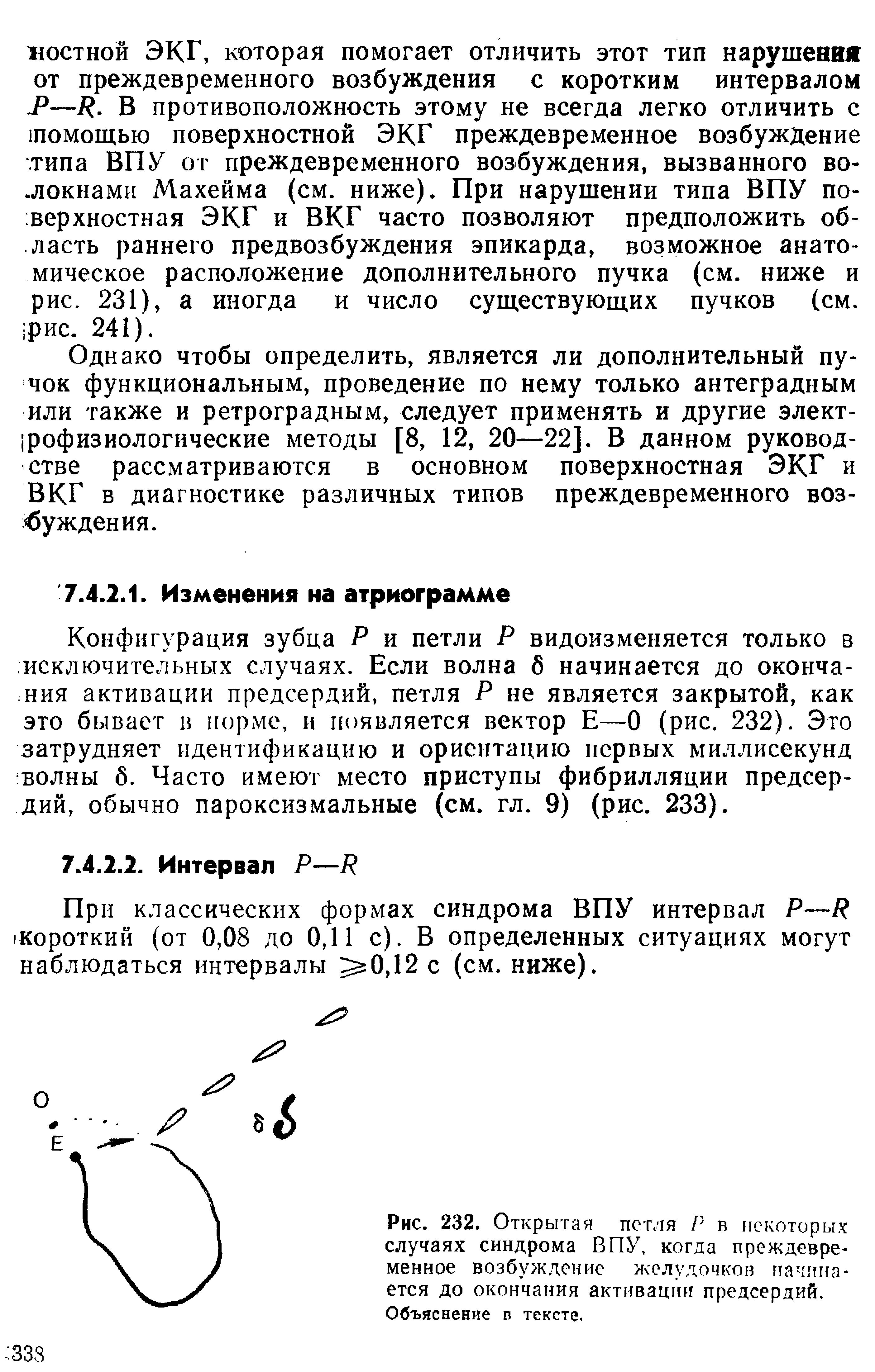 Рис. 232. Открытая петля Р в некоторых случаях синдрома ВПУ, когда преждевременное возбуждение желудочков начинается до окончания активации предсердий. Объяснение в тексте.