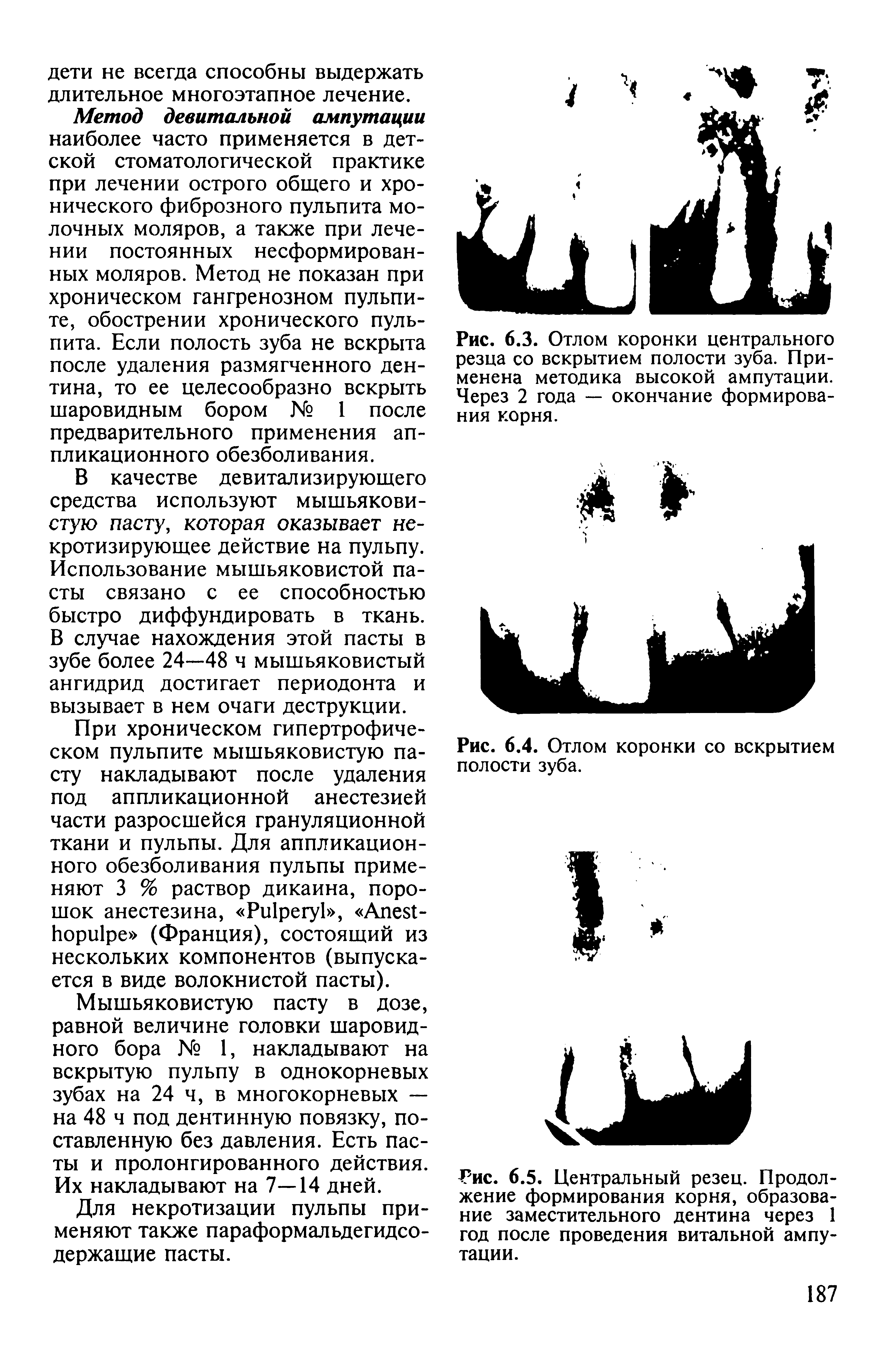 Рис. 6.5. Центральный резец. Продолжение формирования корня, образование заместительного дентина через 1 год после проведения витальной ампутации.