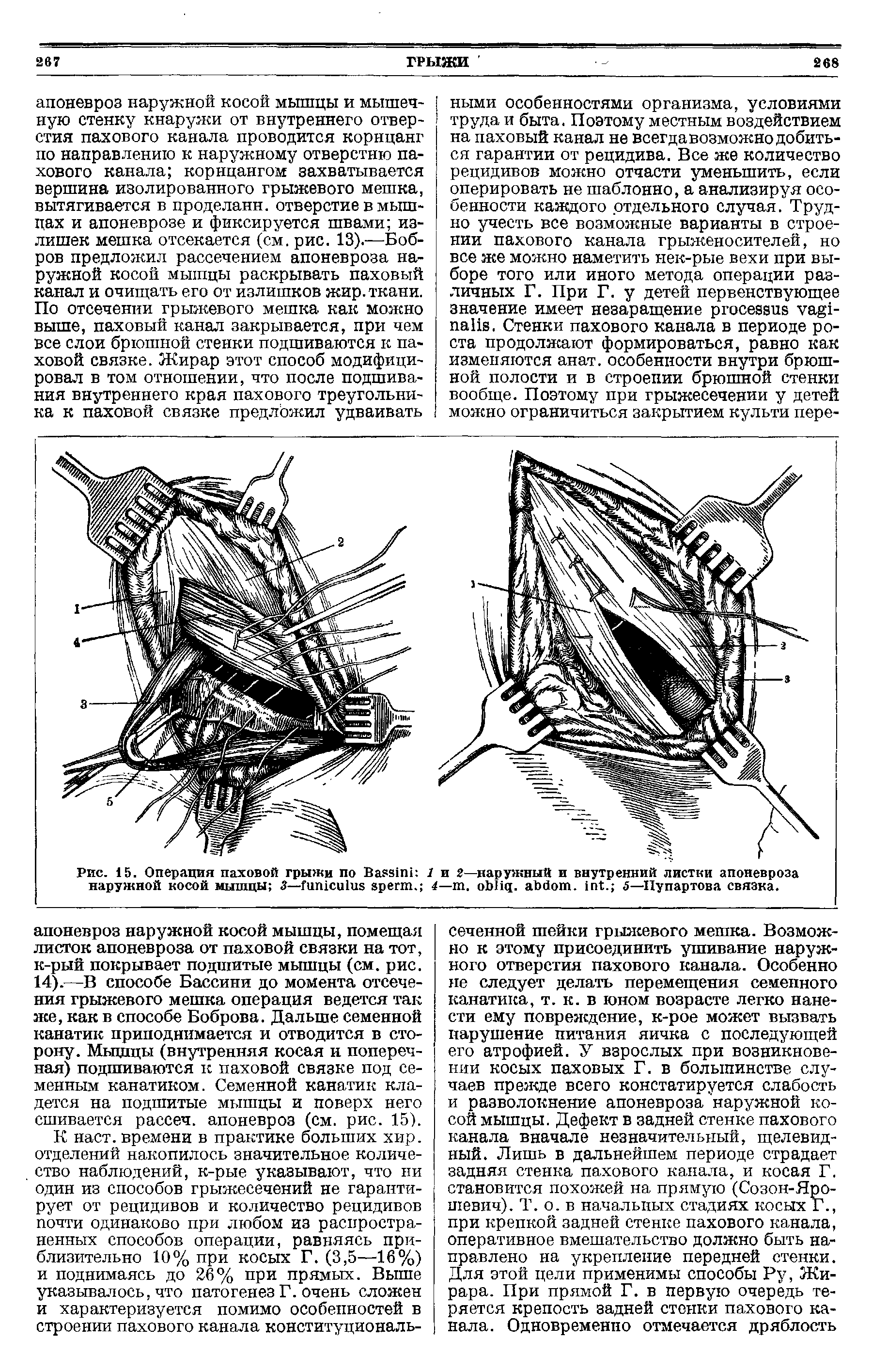 Рис. 15. Операция паховой грыжи по B 1 и 2—наружный и внутренний листки апоневроза наружной косой мышцы 3— . 4— . . . . 5—Пупартова связка.