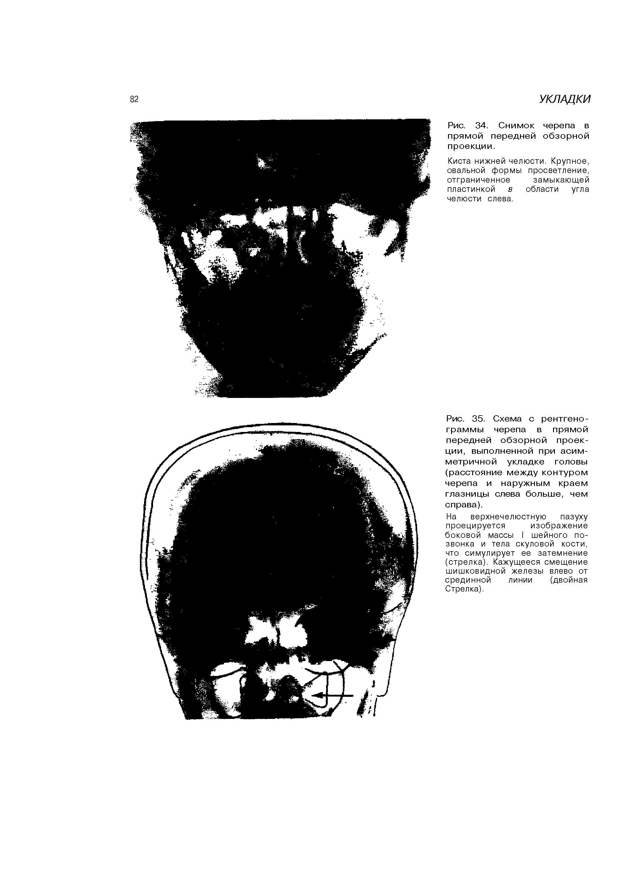 Рис. 35. Схема с рентгенограммы черепа в прямой передней обзорной проекции, выполненной при асимметричной укладке головы (расстояние между контуром черепа и наружным краем глазницы слева больше, чем справа).