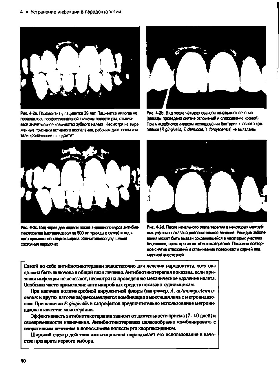 Рис. <-24. После нмльиого этапа терапии а нехотооых межзубных участках показано дополнительное лечение. Рецидив заболевания может быть вызван сохранившейся а некоторых участках биопленки, несмотря на антибиотикотерапию Показано повторное снятие отложений и сглаживание поверхности корней пса...