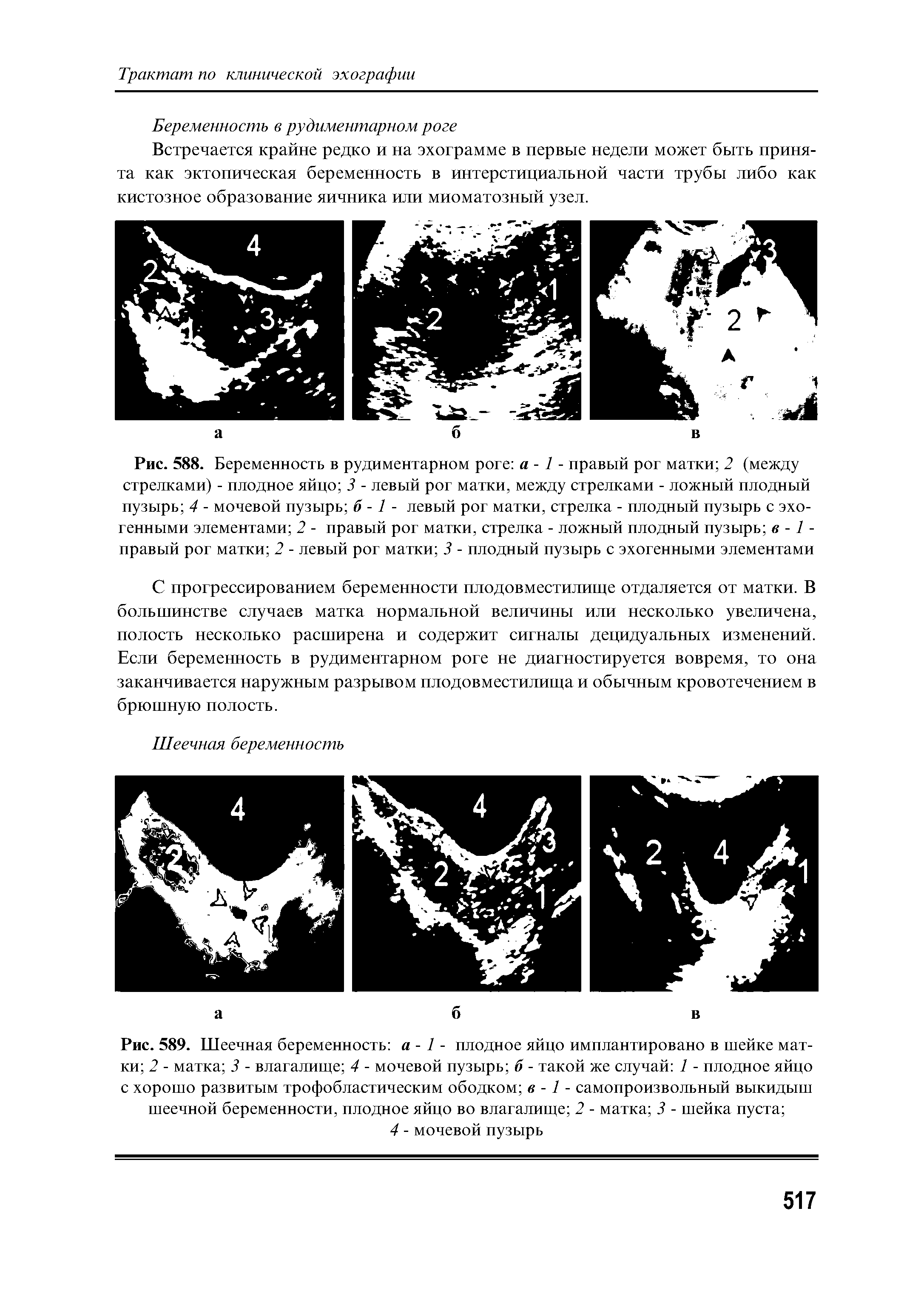 Рис. 589. Шеечная беременность а - 1 - плодное яйцо имплантировано в шейке матки 2 - матка 3 - влагалище 4 - мочевой пузырь б - такой же случай 1 - плодное яйцо с хорошо развитым трофобластическим ободком в -1 - самопроизвольный выкидыш шеечной беременности, плодное яйцо во влагалище 2 - матка 3 - шейка пуста ...