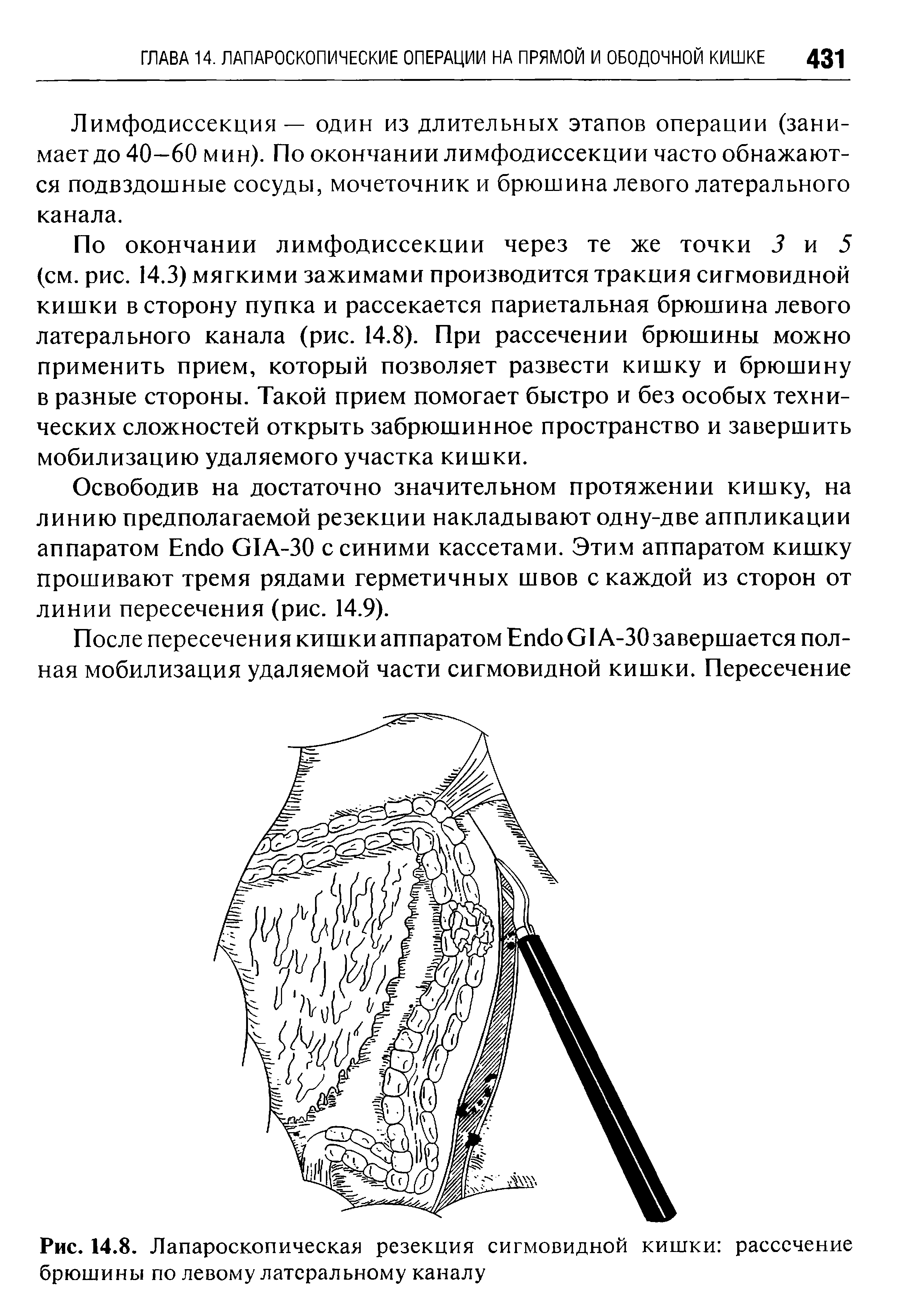 Рис. 14.8. Лапароскопическая резекция сигмовидной кишки рассечение брюшины по левому латеральному каналу...