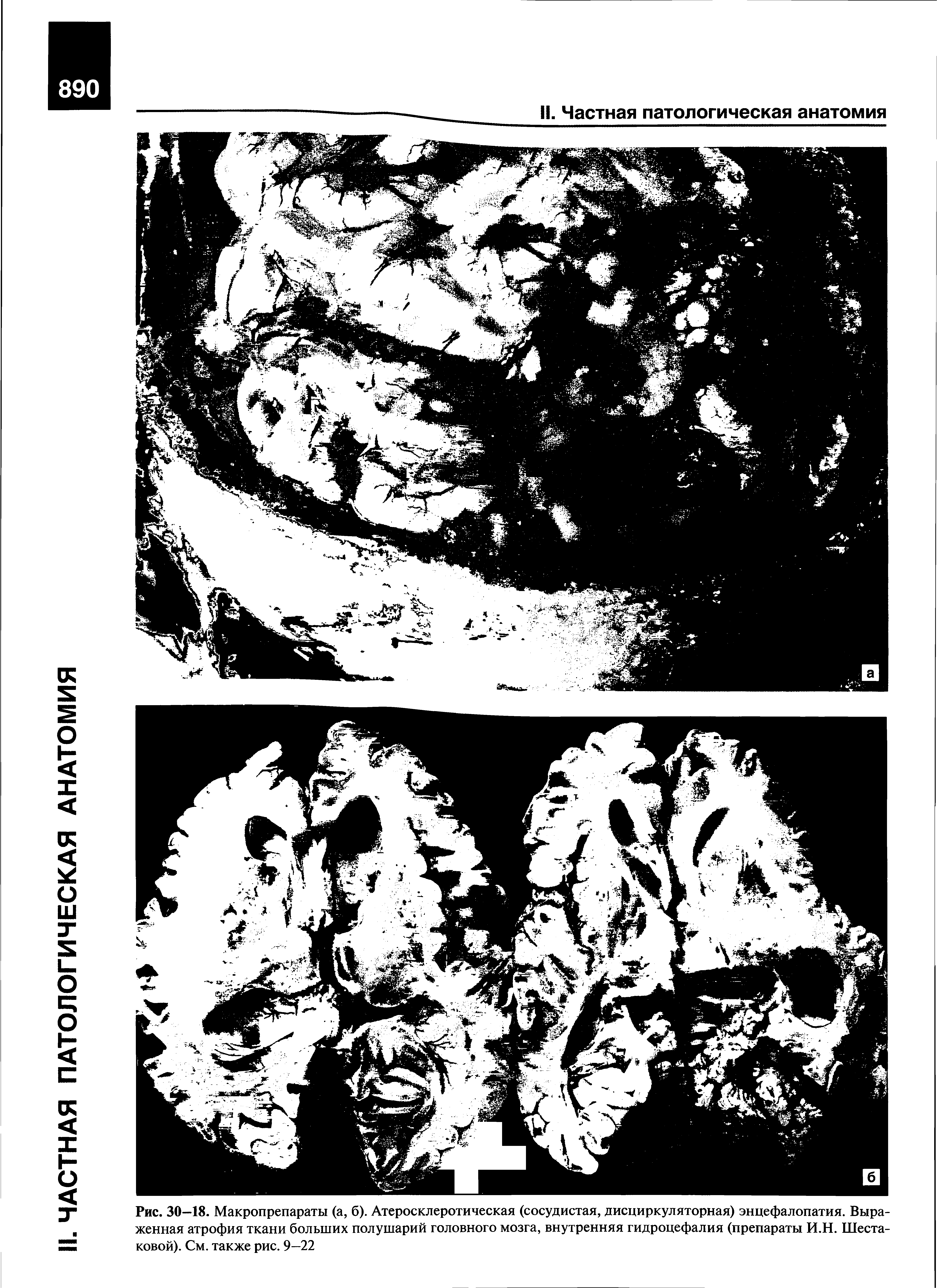 Рис. 30—18. Макропрепараты (а, б). Атеросклеротическая (сосудистая, дисциркуляторная) энцефалопатия. Выраженная атрофия ткани больших полушарий головного мозга, внутренняя гидроцефалия (препараты И.Н. Шестаковой). См. также рис. 9—22...